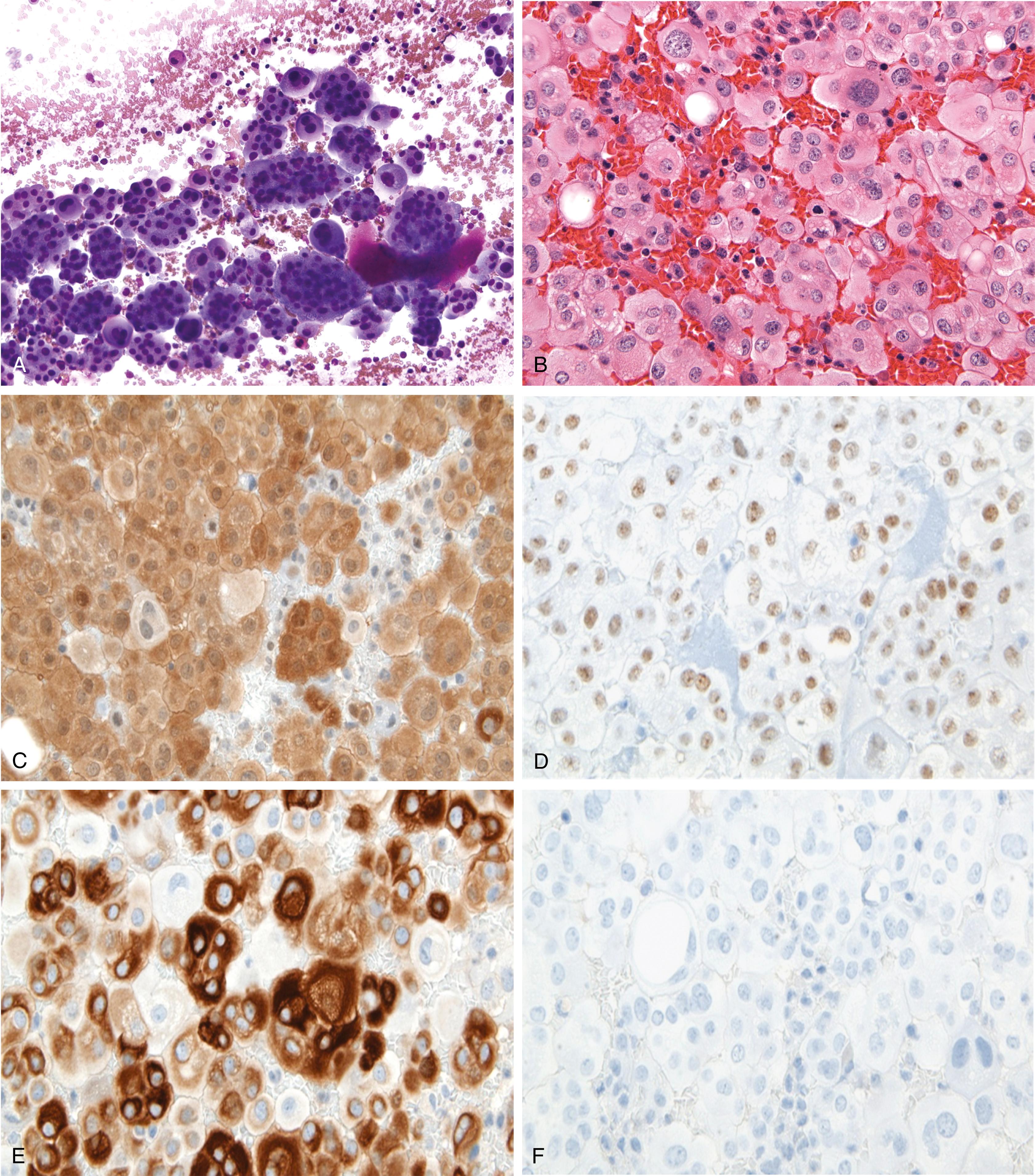 Fig. 21.6, (A–F) Malignant mesothelioma with immunostain profile. The fluid specimen shows numerous large, cohesive clusters of mesothelial cells with atypia in the cytospin and cell block sections (A and B, original magnification ×400). Immunostains performed on the cell block were positive for calretinin (C, original magnification ×400), Wilms tumor 1 (D, original magnification ×400), cytokeratin 7 (E, original magnification ×400), and cytokeratin 5/6 but was negative for BerEP4 and MOC-31 (F, original magnification ×400).