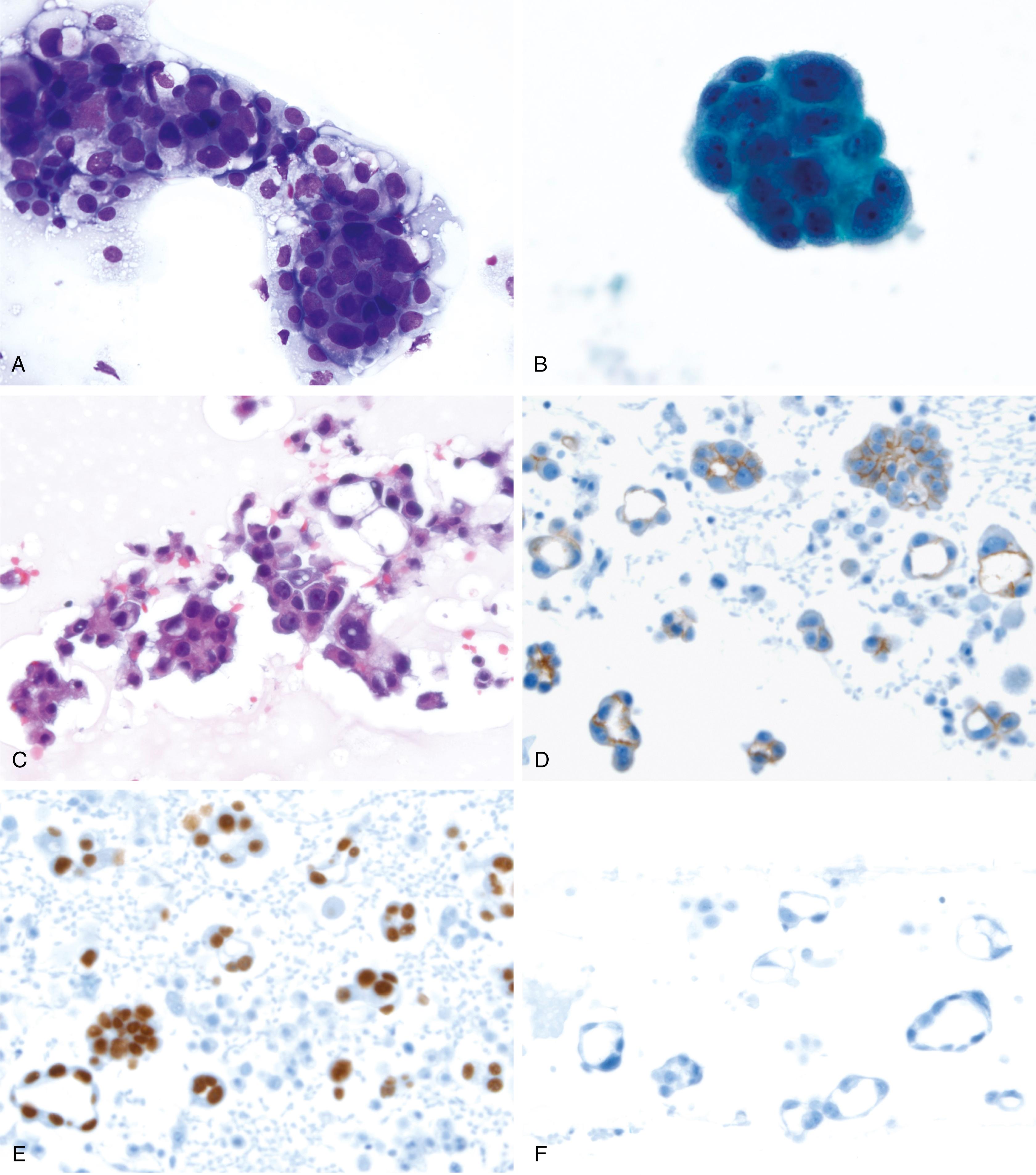 Fig. 21.9, (A–F) Metastatic adenocarcinoma of breast origin in pleural fluid (original magnification ×400). The cytospin, ThinPrep, and cell block specimens showed cells with nuclear enlargement, prominent nucleoli, and glassy cytoplasm (A–C). Given the resemblance of these tumor cells to mesothelial cells, in a so-called mesothelioma pattern, immunocytochemistry is important to exclude reactive or neoplastic mesothelial cells. The cells stained positive for BerEP4 (D) and estrogen receptor (E), whereas they were negative for calretinin and Wilms tumor 1 (F).