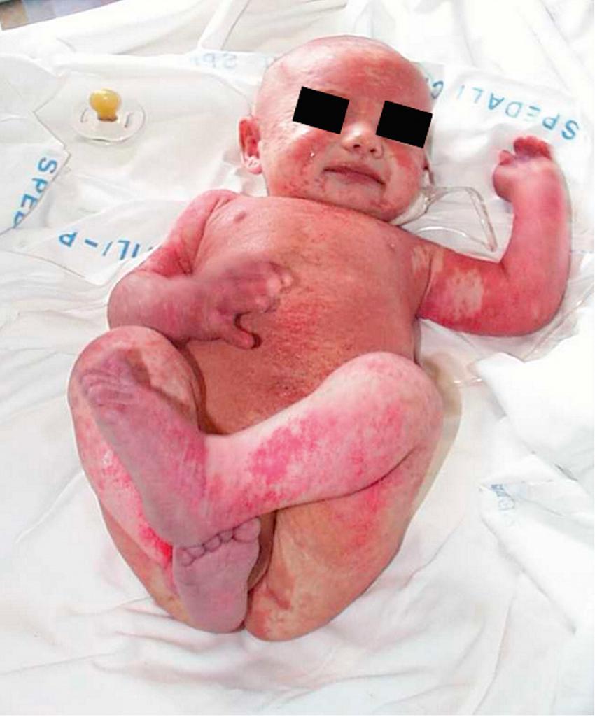 Fig. 152.2, Typical clinical features in an infant with Omenn syndrome.
