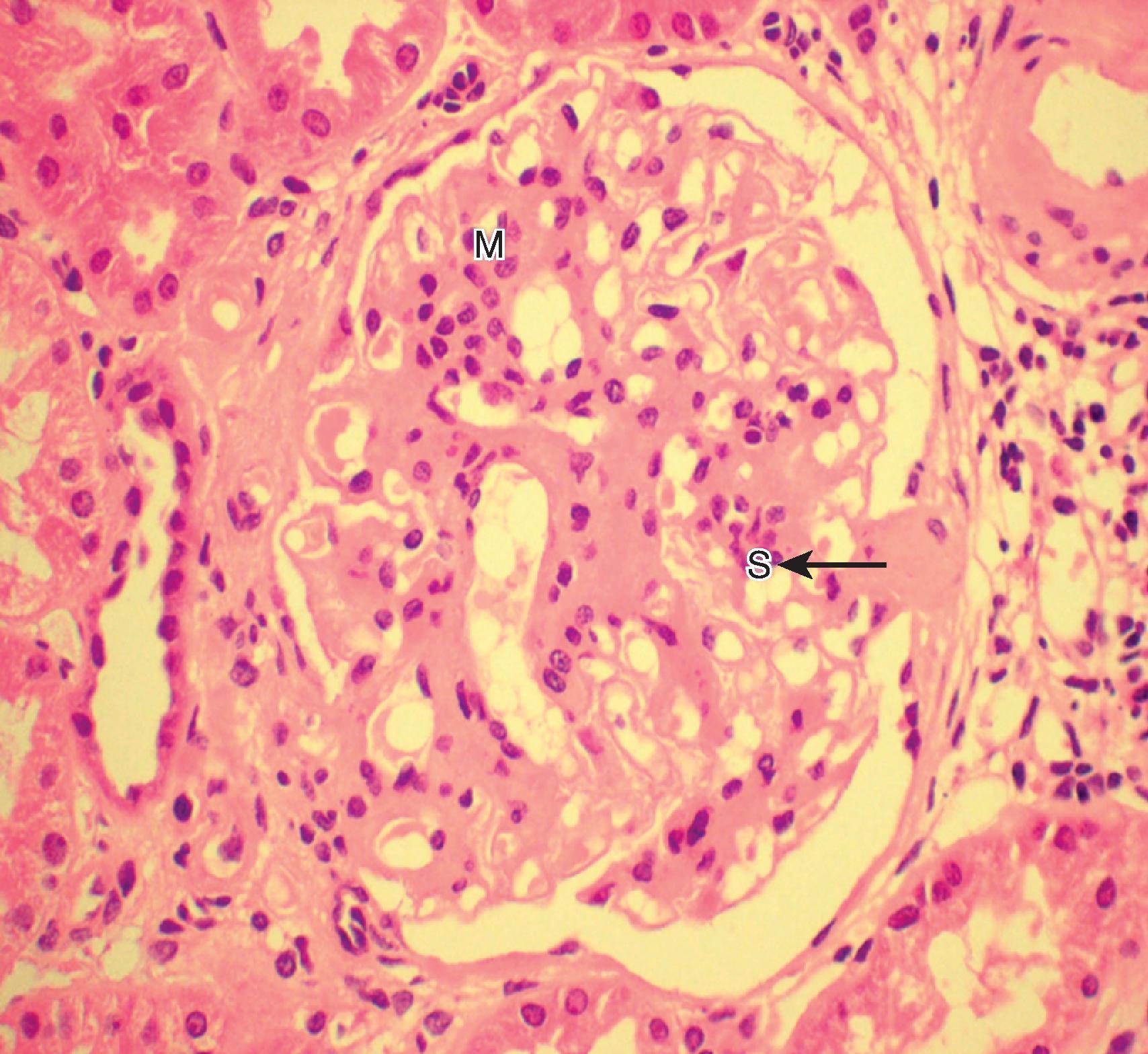 Fig. 21.1, Kidney biopsy showing mesangial proliferation (M) and expansion of the mesangial extracellular matrix (S) in a patient with immunoglobulin A (IgA) nephropathy. A capsular adhesion can also be seen (arrow) .