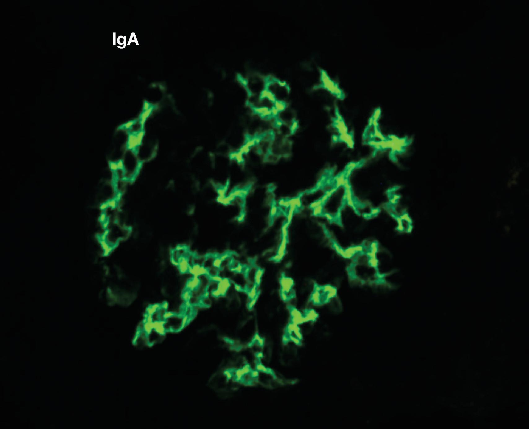 Fig. 21.2, Kidney biopsy showing immunofluorescent staining for mesangial immunoglobulin A (IgA) .