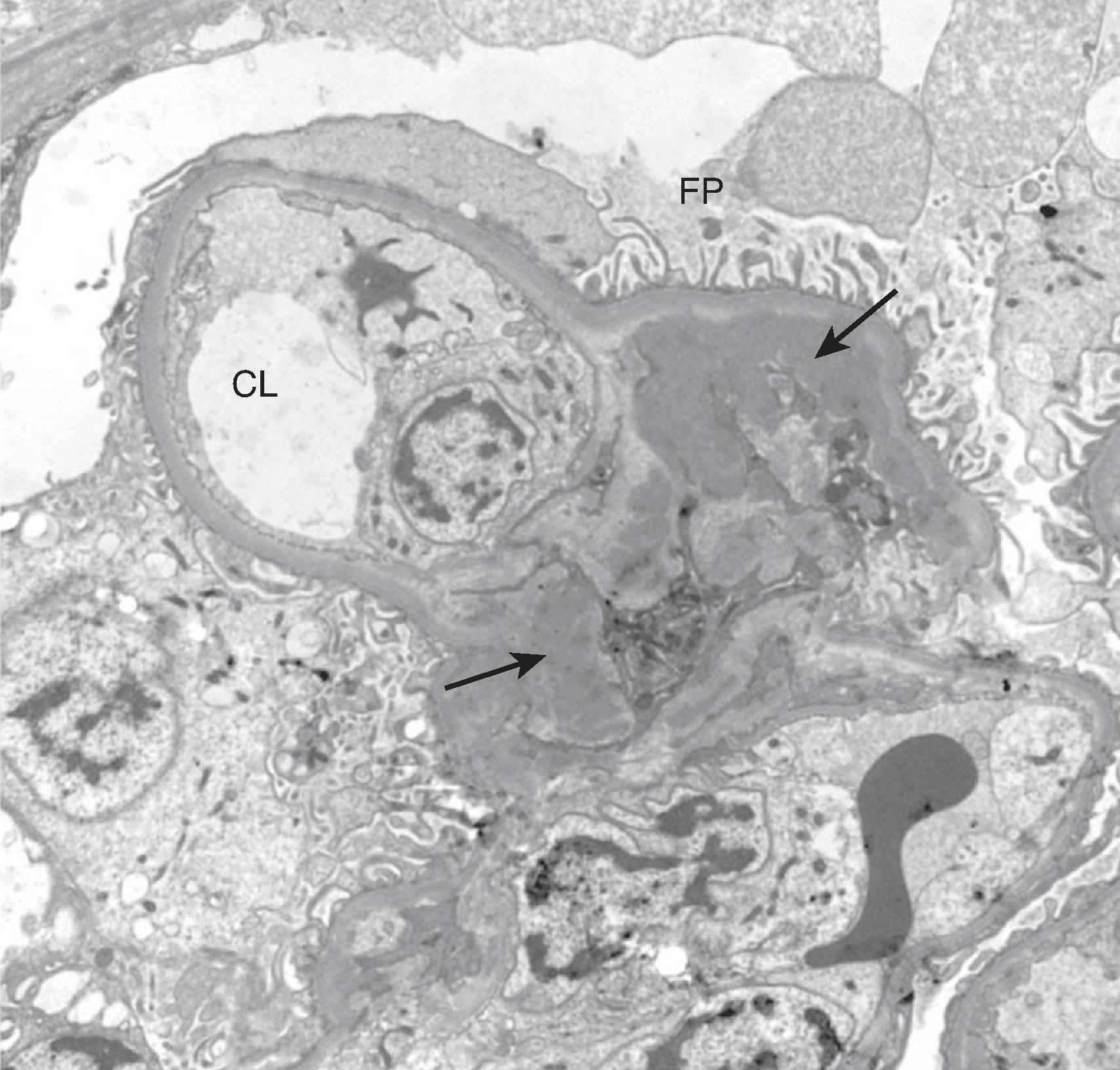 Fig. 21.3, Electron micrograph showing immunoglobulin A immune complex deposition within the mesangium and paramesangium (arrows) . CL, Capillary loops; FP, normal podocyte foot processes.