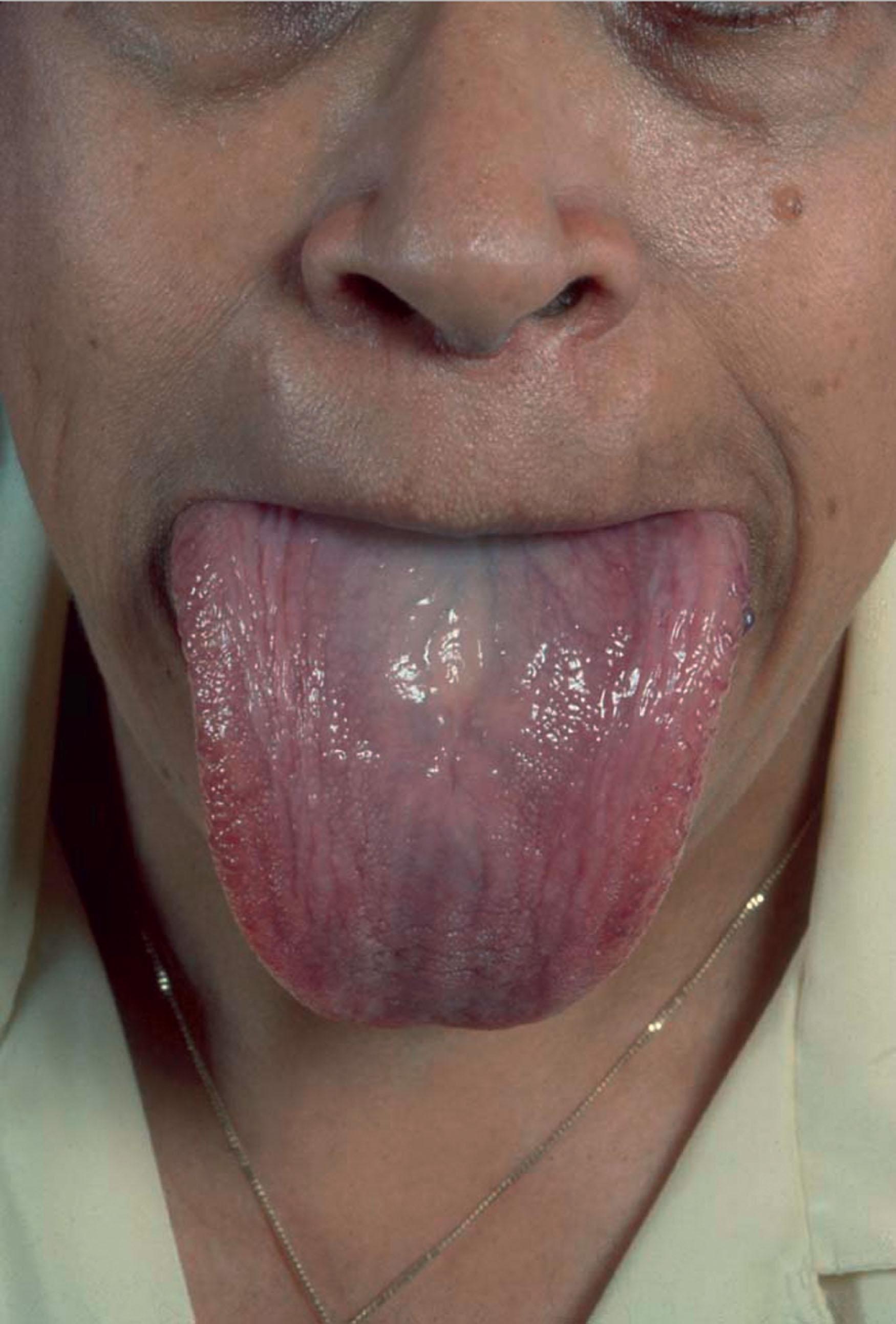 Figure 93.3, ENLARGED TONGUE INFILTRATED BY AMYLOID DEPOSITS.