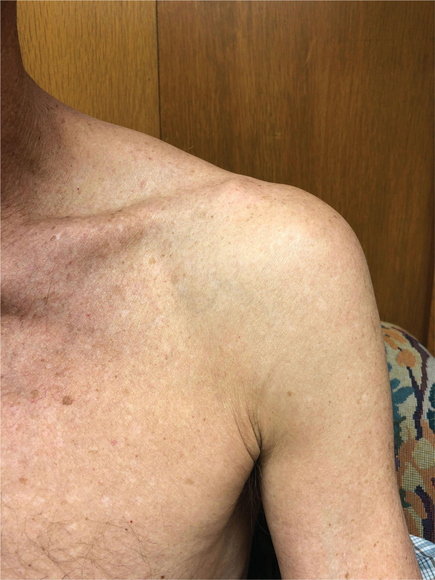 Figure 93.5, SHOULDER PAD SIGN.