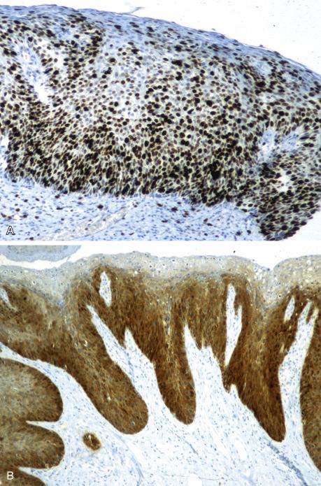 FIG. 20.1, Vulvar high-grade squamous intraepithelial lesion (vulvar intraepithelial neoplasia usual type, VIN III). There is nuclear staining for Ki67 extending to upper epithelial layers (A) and continuous nuclear and cytoplasmic staining for p16 in the lower half of the epithelium (B).