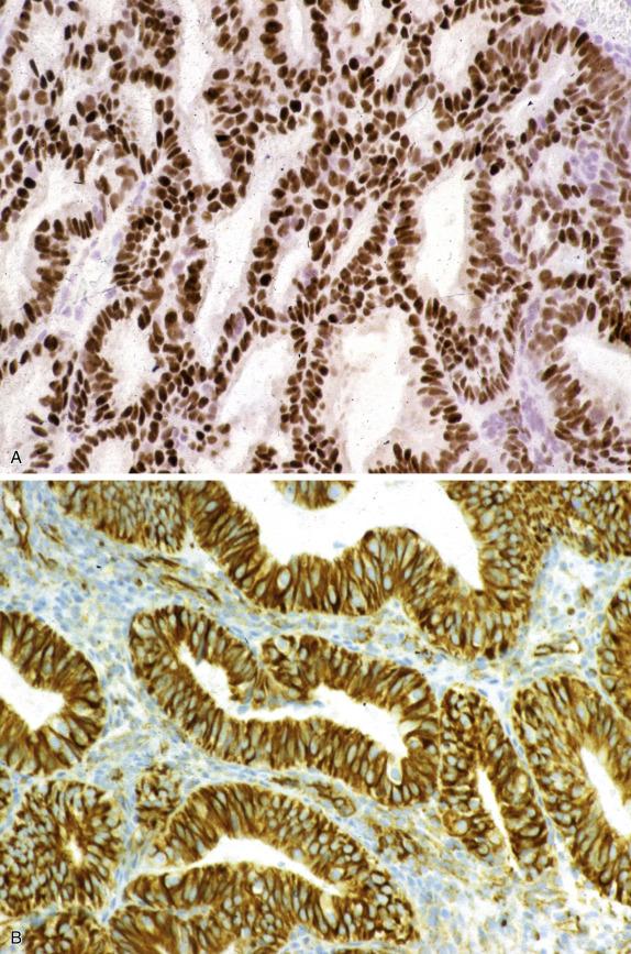 FIG. 20.11, Endometrial adenocarcinoma, endometrioid type. Most cases have diffuse nuclear estrogen receptor positivity (A) and diffuse vimentin positivity, which is characteristically cytoplasmic with membranous accentuation (B).