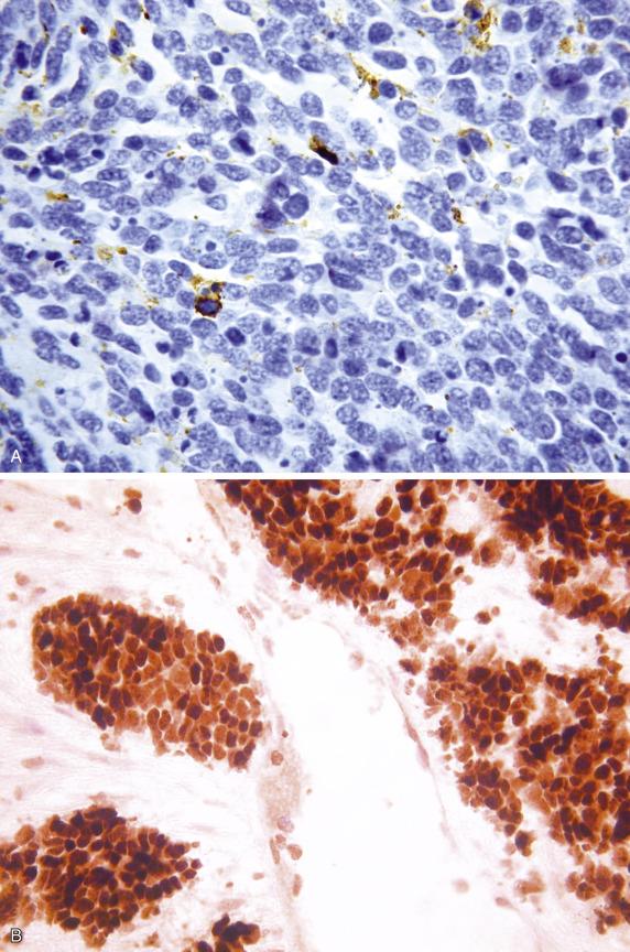 FIG. 20.13, Cervical large cell neuroendocrine carcinoma. Chromogranin expression can be focal with a punctate cytoplasmic pattern (A). These tumors are often positive with TTF1, limiting the use of this marker in the distinction between primary cervical and metastatic pulmonary neuroendocrine carcinoma (B).