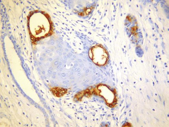 FIG. 20.14, Tubulosquamous polyp of the vagina. The glandular component is positive with prostatic-specific antigen (PSA).