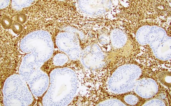 FIG. 20.15, Atypical endometrial hyperplasia/endometrioid intraepithelial neoplasia. Most lesions show loss of PTEN staining. The surrounding stroma and nonneoplastic glands serve as a positive internal control.