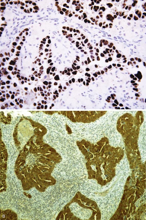 FIG. 20.16, Endometrial serous carcinoma. The tumor cells exhibit strong diffuse p53 positivity (abnormal pattern) (A) and are diffusely positive with p16 (B).