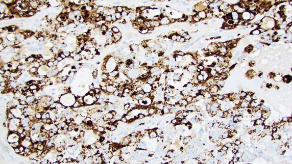 FIG. 20.17, Endometrial clear cell carcinoma. Expression of Napsin-A in this example is diffuse, but focal positivity is not infrequently encountered in this tumor type.