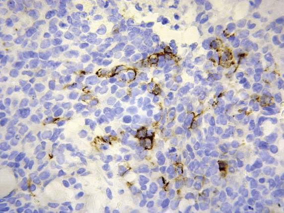 FIG. 20.18, Undifferentiated endometrial carcinoma. Expression of cytokeratins is frequent but may be focal (only isolated tumor cells are positive).