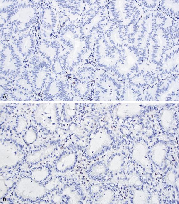 FIG. 20.20, Endometrial endometrioid carcinoma. In these two examples there is loss of MSH6 (A) and PMS2 (B) nuclear expression. The intervening stroma acts as an internal positive control.