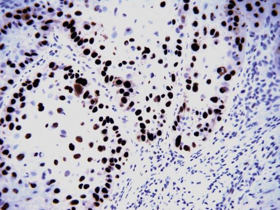 FIG. 20.2, Differentiated VIN. The lesion shows intense p53 immunoreactivity involving the basal and parabasal cell layers.