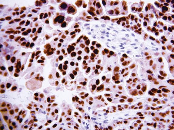 FIG. 20.21, Tubo-ovarian high-grade serous carcinoma. The tumor shows diffuse strong nuclear WT1 positivity.