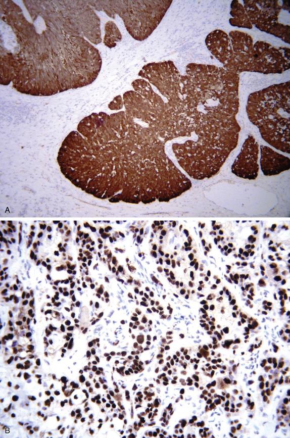 FIG. 20.3, Vulvar squamous cell carcinoma, human papillomavirus (HPV)- and non-HPV-related types. HPV-related vulvar squamous cell carcinoma shows strong and diffuse immunoreactivity for p16 (A). Diffuse p53 immunoreactivity is seen in a non-HPV-related vulvar squamous cell carcinoma (B).