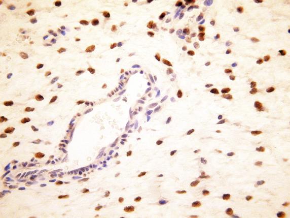 FIG. 20.5, Vulvar aggressive angiomyxoma. There is diffuse nuclear HMGA2 positivity.