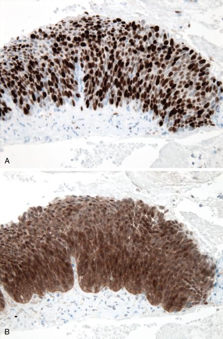 FIG. 20.6, Cervical high-grade squamous intraepithelial lesion (CIN3). The presence of diffuse nuclear staining for Ki67 (A) and diffuse nuclear and cytoplasmic p16 staining throughout the full epithelial thickness (B) supports this diagnosis.