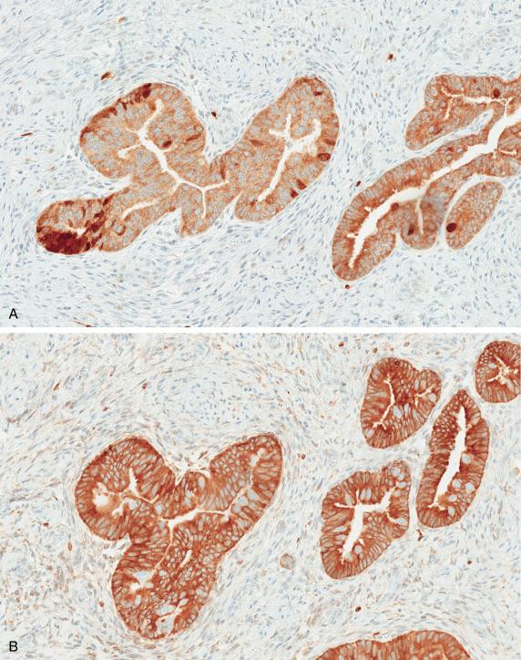 FIG. 20.8, Cervical tuboendometrioid metaplasia. There is only patchy and mostly cytoplasmic staining for p16 (A), as well as diffuse immunoreactivity with BCL-2 (B) and estrogen receptor (C).