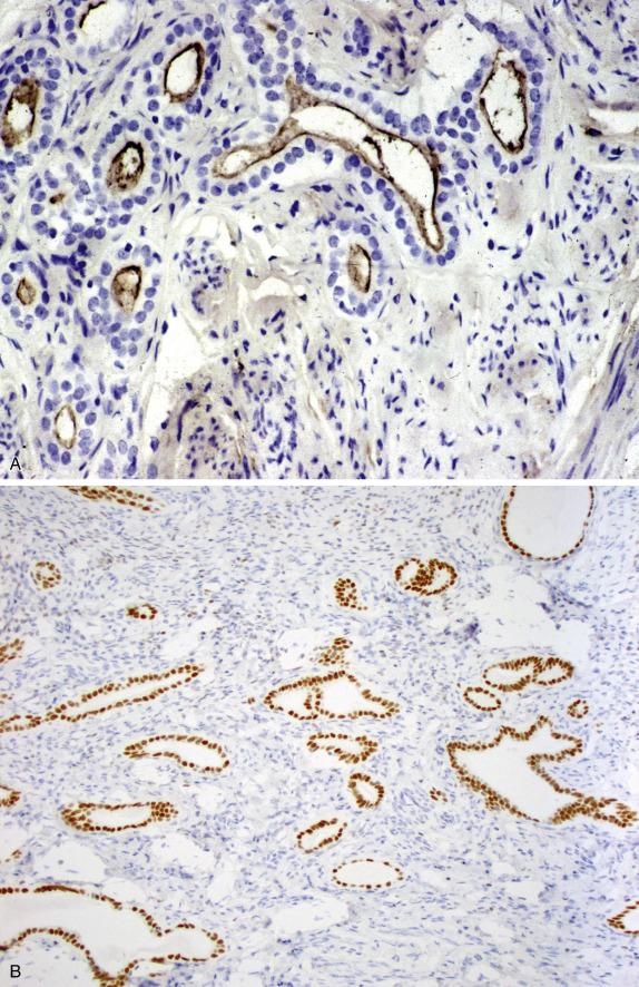 FIG. 20.9, Cervical mesonephric remnants. The glandular elements exhibit CD10 luminal staining (A) and nuclear immunoreactivity with GATA3 (B).