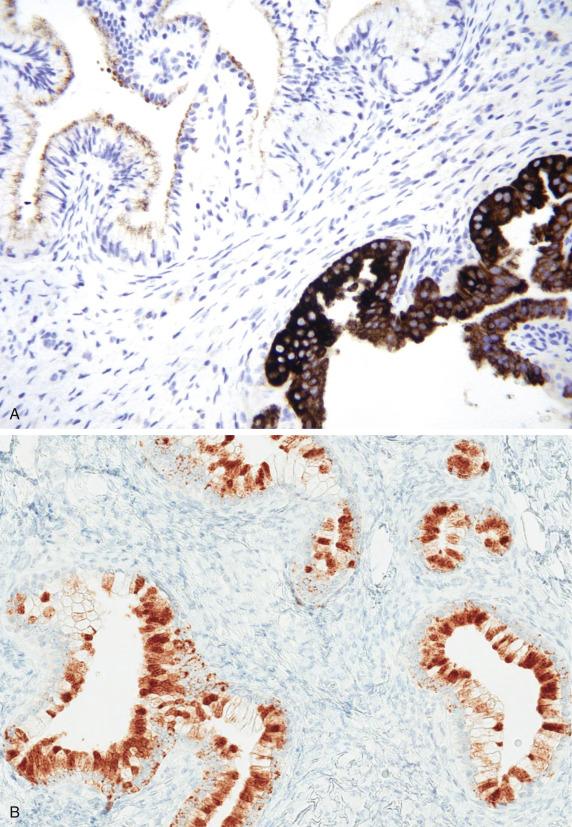 FIG. 20.10, Cervical gastric type adenocarcinoma. Expression of pyloric-type glandular markers is common, including MUC6 (A) and HIK1083 (B). p53 expression is abnormal (overexpressed) (C).