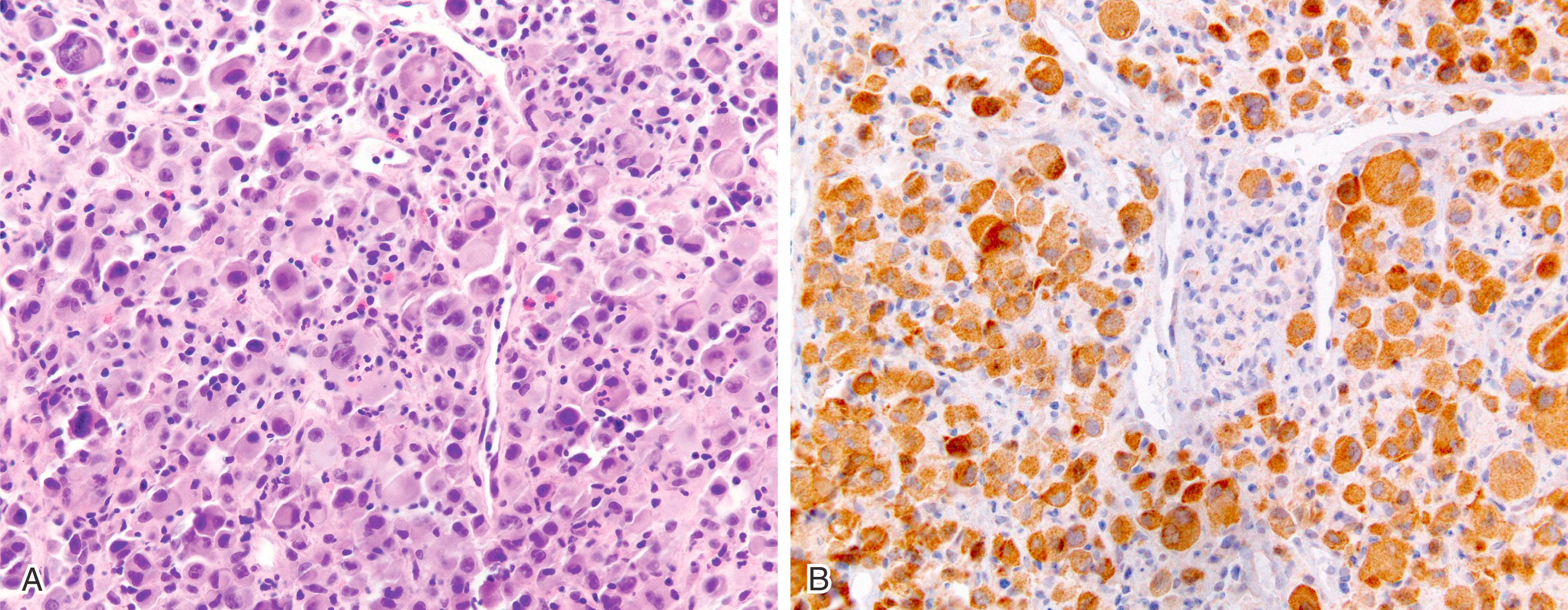 Fig. 8.1, This epithelioid malignant neoplasm presented in the axilla (A). Broad-spectrum cytokeratins, S100, SOX10, human melanoma black 45 (HMB-45), and melan A were negative (not shown). The BRAF V600E mutation-specific antibody was positive (B), supporting a diagnosis of metastatic undifferentiated melanoma.