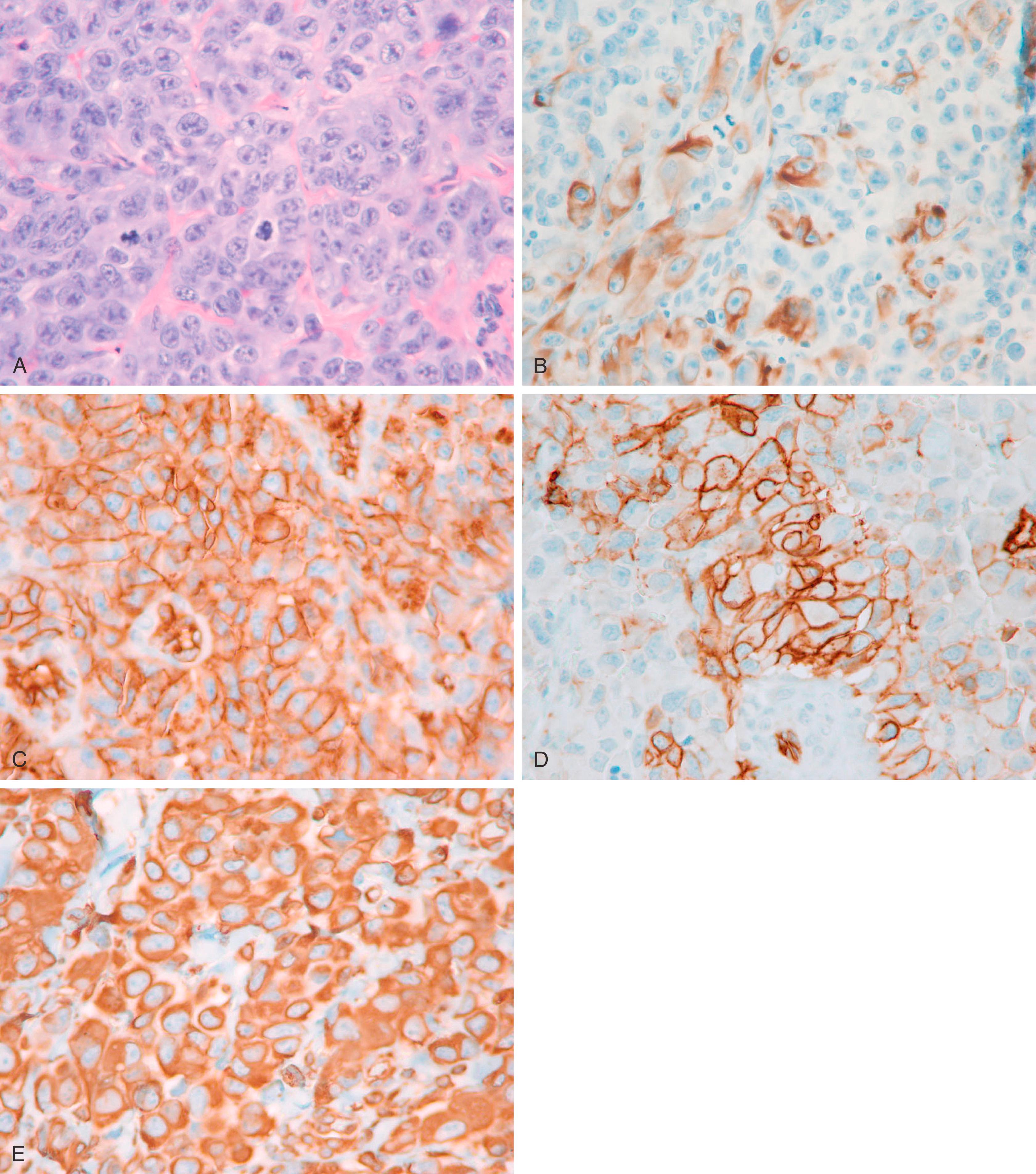 Fig. 8.3, This high-grade tumor (A) located in the vulvar area showed patchy staining for CK7 (B) and CAM5.2 (not shown). The tumor was negative for all other epithelial markers. Diffuse strong reactivity for CD31 (C), CD34 (D), and vimentin (E) supported the correct diagnosis of postradiation angiosarcoma. Patient was treated with radiation therapy for vulvar squamous cell carcinoma several years ago.