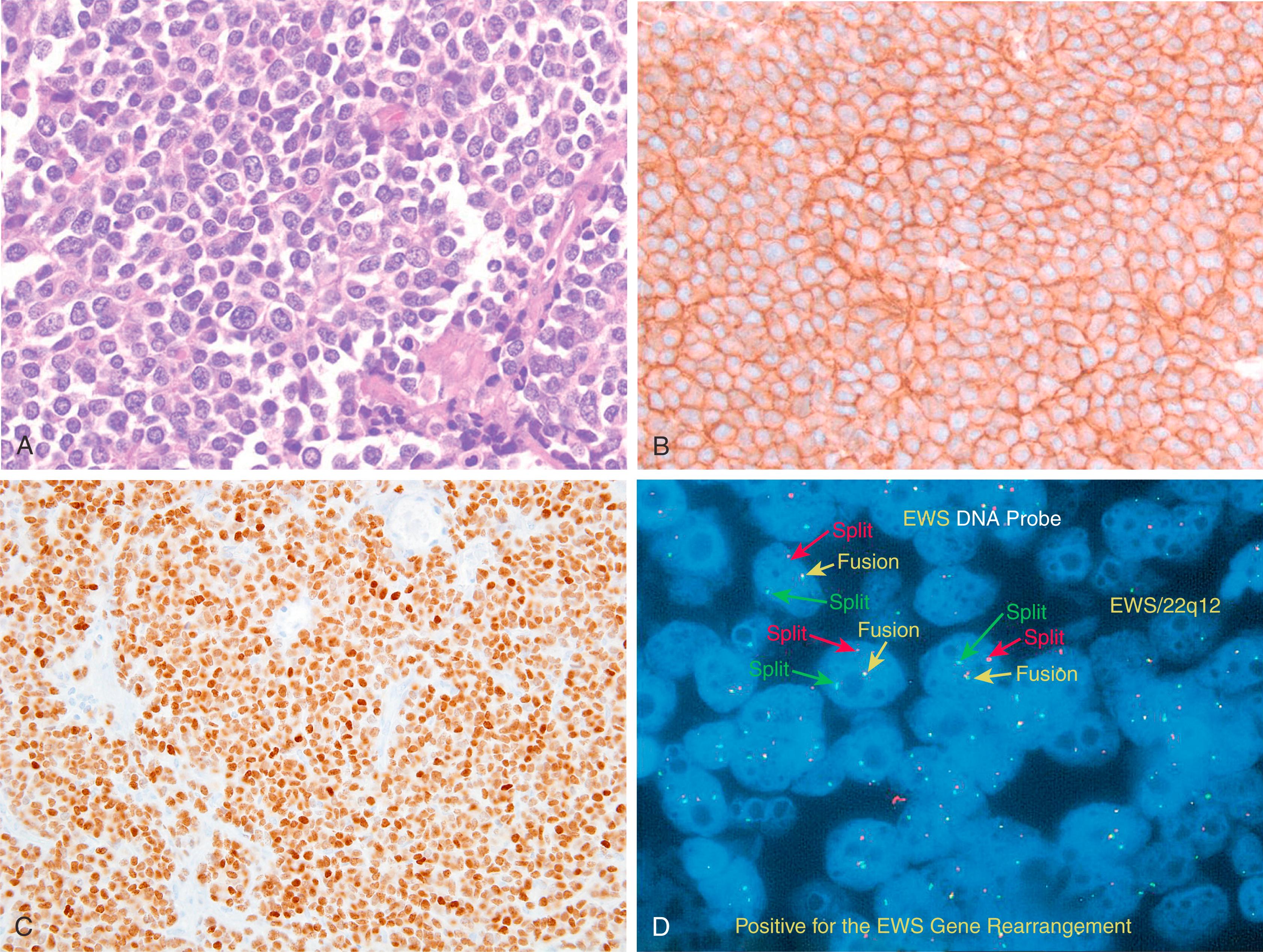 Fig. 8.4, Undifferentiated tumor (A) in the pelvis of a 40-year-old woman was positive for CD99 (B) and NKX2.2 (C), but negative for all other stains (case contributed by Dr. Esther Elishaev) . Fluorescence in situ hybridization with EWSR1 break-apart probe demonstrates one red-green fusion signal and one split signal (D) consistent with EWSR1 gene rearrangement and supports the diagnosis of extraskeletal Ewing sarcoma.