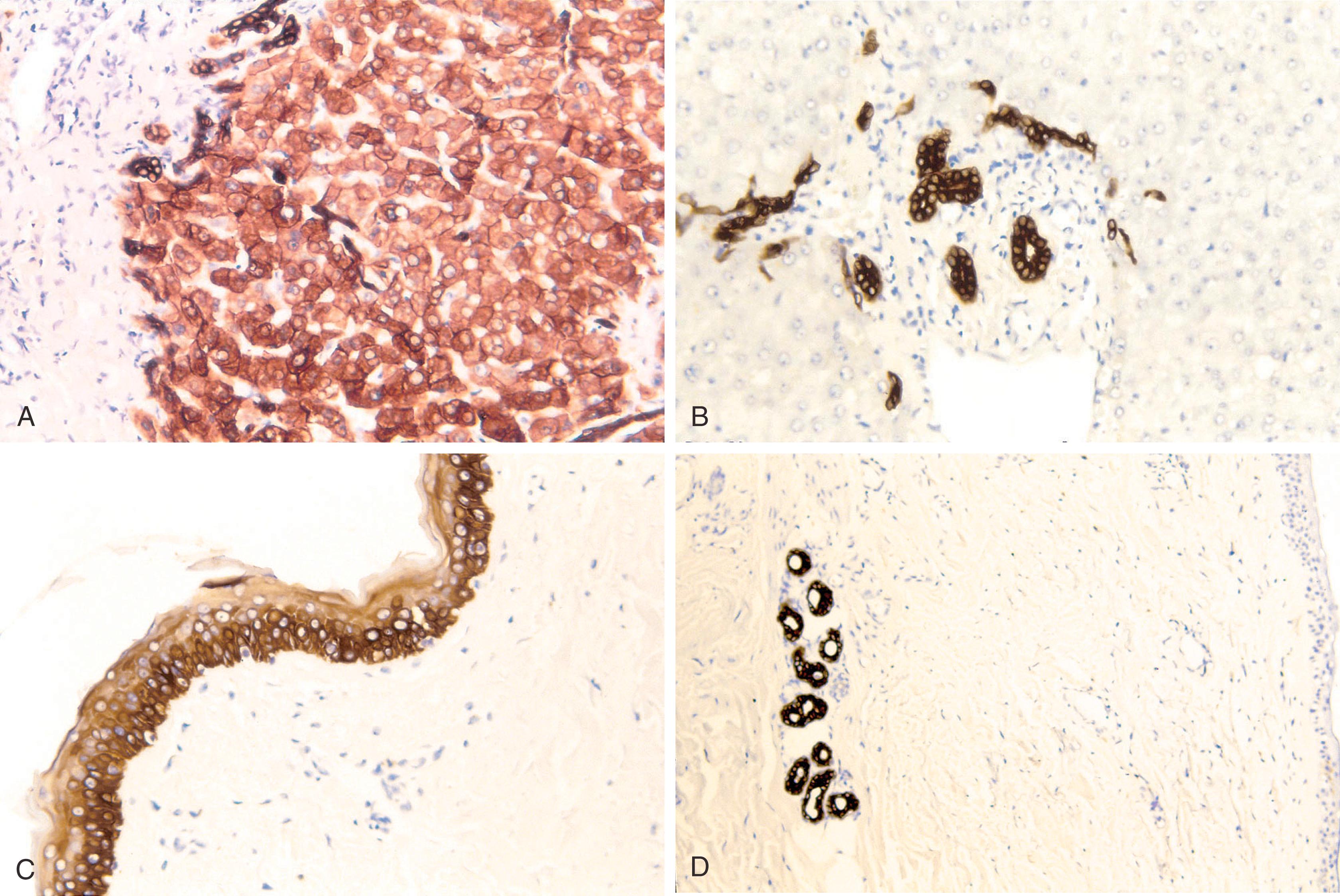 Fig. 8.5, CAM5.2 stains liver and adjacent bile ducts (A), whereas keratin 34βE12 (K903) stains bile ducts (B) and stratum corneum of skin (C). CAM 5.2 and 35βH11 stains only eccrine coils and not epidermis (D).