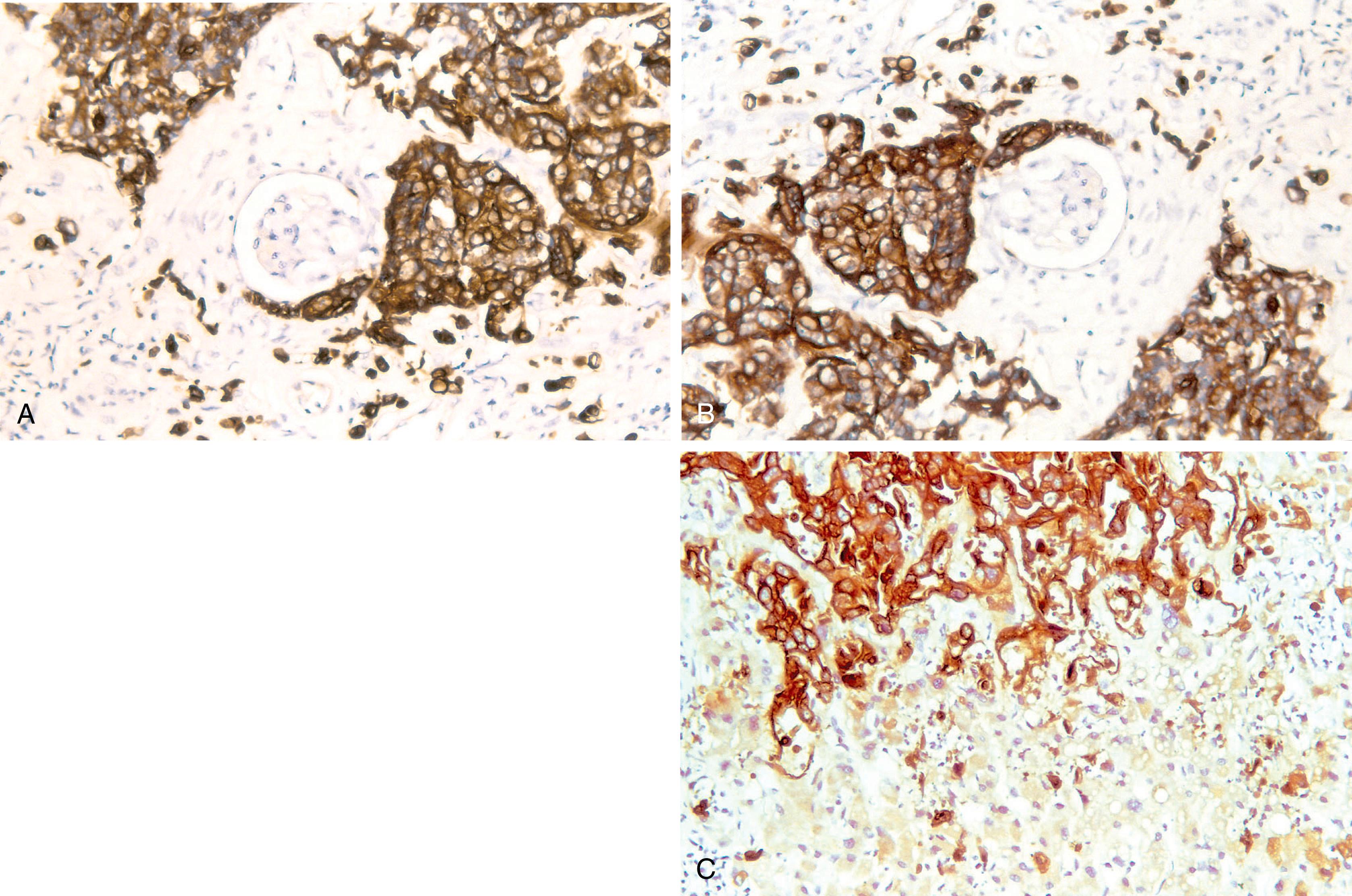 Fig. 8.6, Urothelial carcinoma of the kidney is immunostained by CK7 (A) and CK20 (B). Metastatic gastrointestinal-derived carcinoma demonstrates strong CK20 reactivity, but hepatic parenchyma is CK20 negative (C).