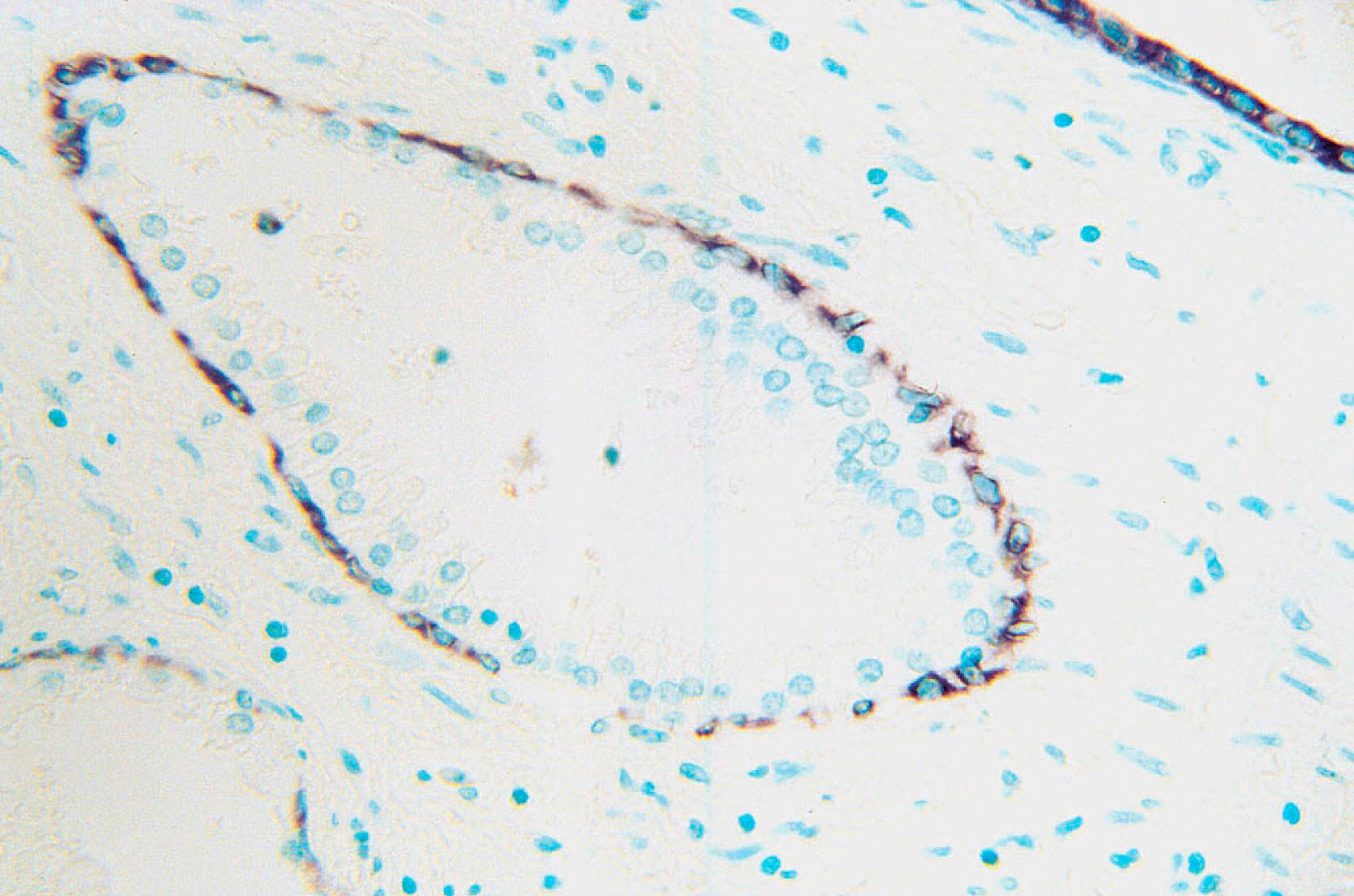 Fig. 8.7, Basal cells in this prostate section are seen with K903. Myoepithelial cells in the breast can also be seen with K903.