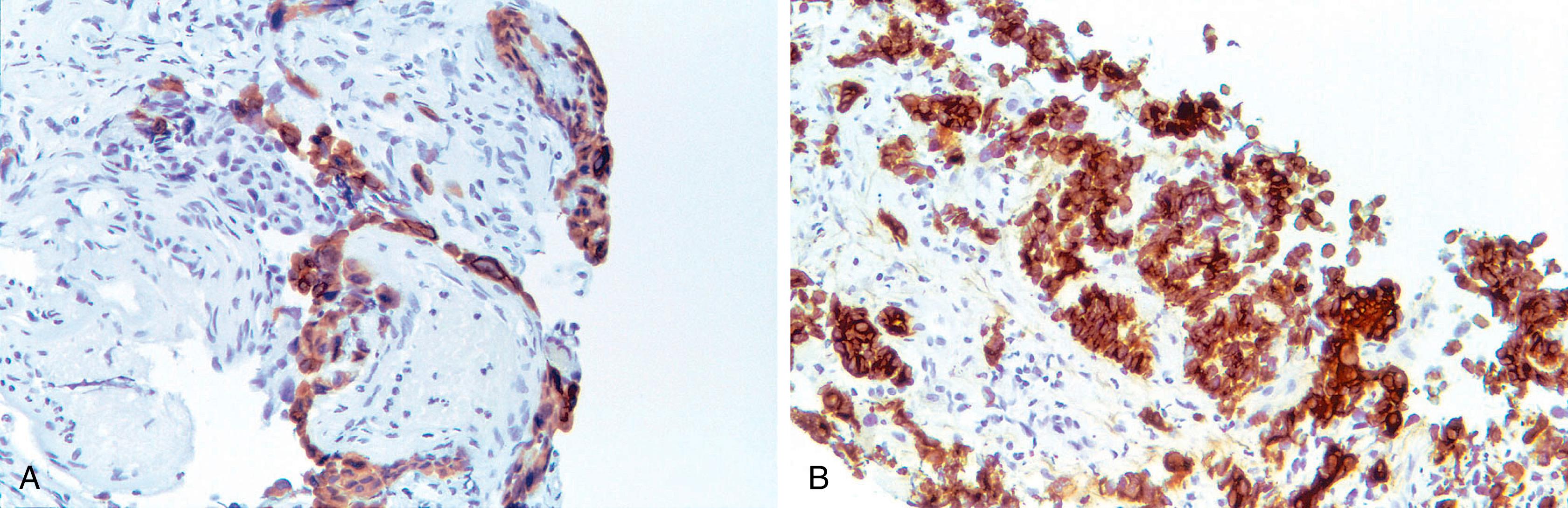 Fig. 8.8, Antibodies to CK5/CK6 strongly immunostain reactive mesothelial cells in a pleural biopsy (A) and epithelioid mesothelioma cells (B).