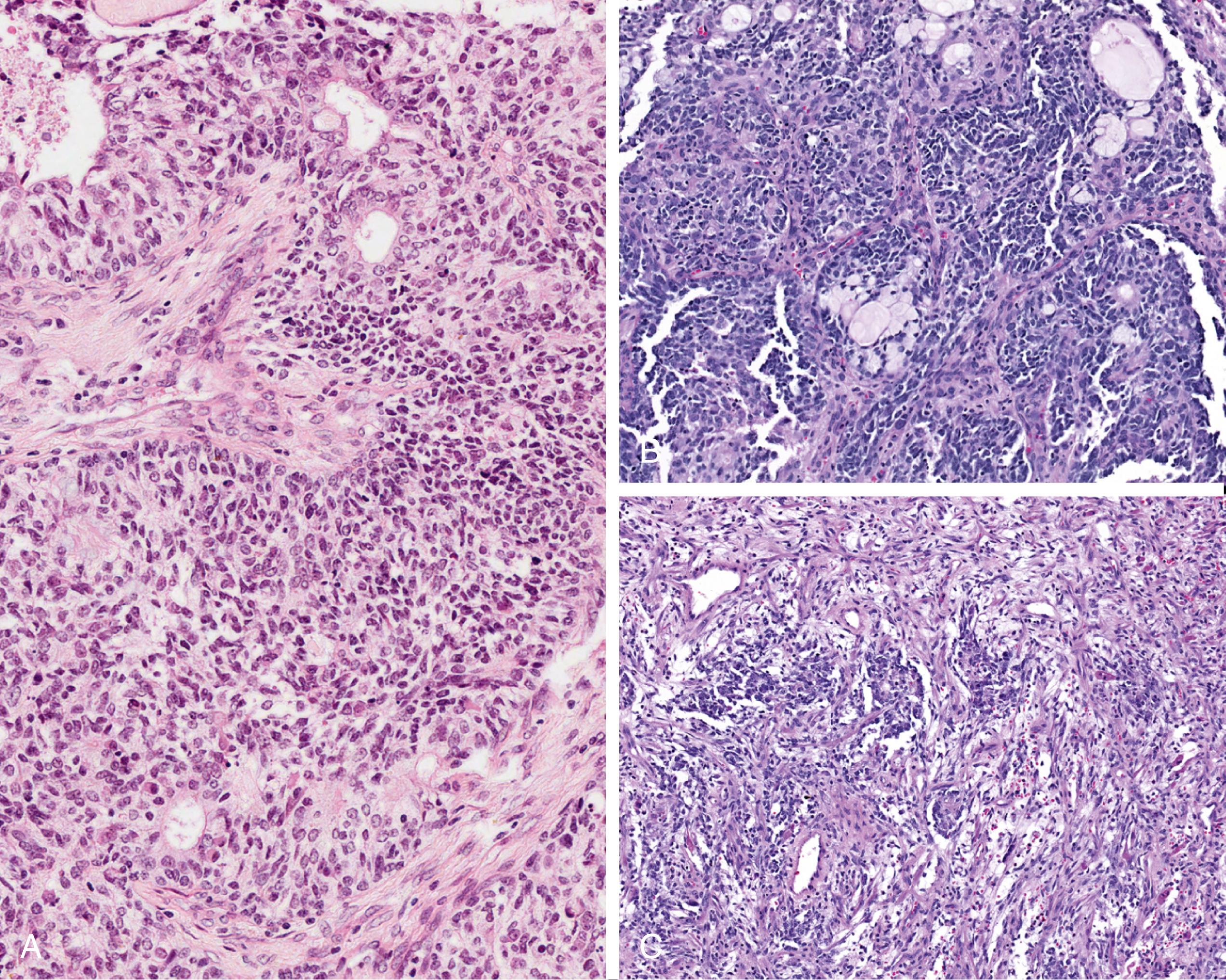 Fig. 9.28, Teratocarcinosarcoma shows carcinoma admixed with sarcoma (including rhabdomyosarcoma) and primitive elements in a teratoma-like pattern. (A) Rhabdomyosarcoma cells juxtaposed to epithelial islands. (B) Primitive cells showing focal rosette formation next to mucocytes. (C) Primitive cells adjacent to spindled sarcoma cells.