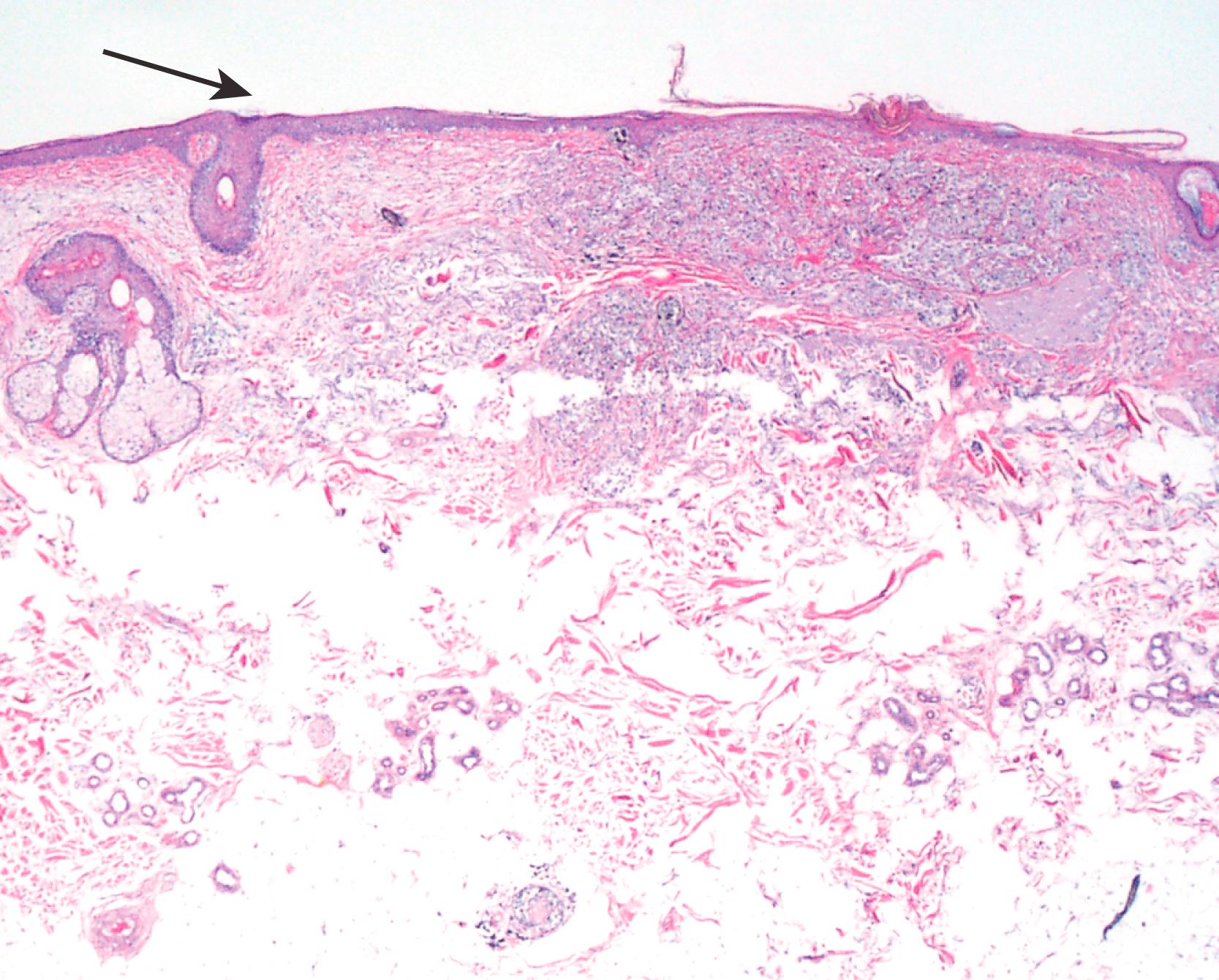 Fig. 7.1, Lentigo maligna–type melanoma, characterized by atypical melanocytes arranged in a confluent pattern in sun-damaged skin. Note the flat pattern of the epidermis with effacement of the rete ridges (arrow) .