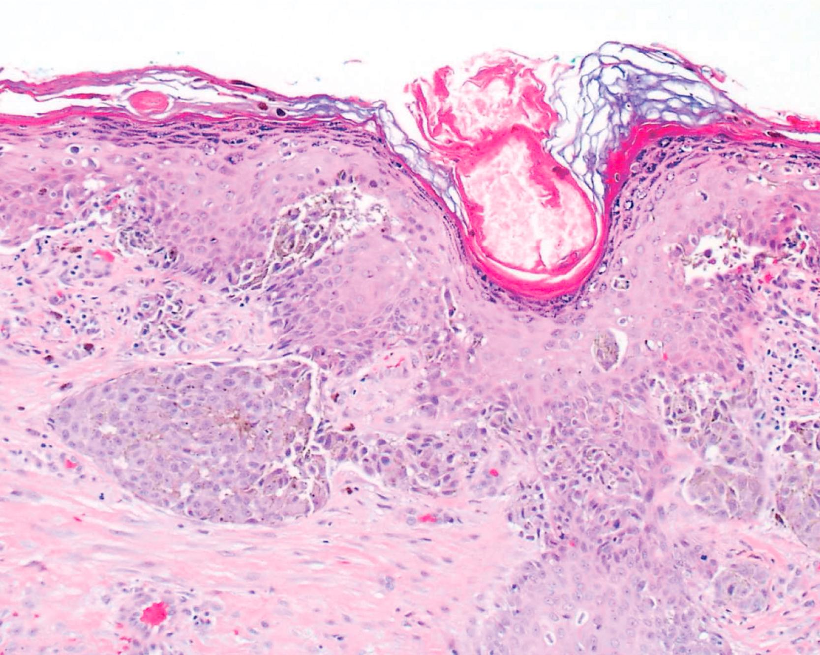 Fig. 7.2, Superficial spreading melanoma. Proliferation of large melanocytes as nests and single cells with pagetoid upward migration.