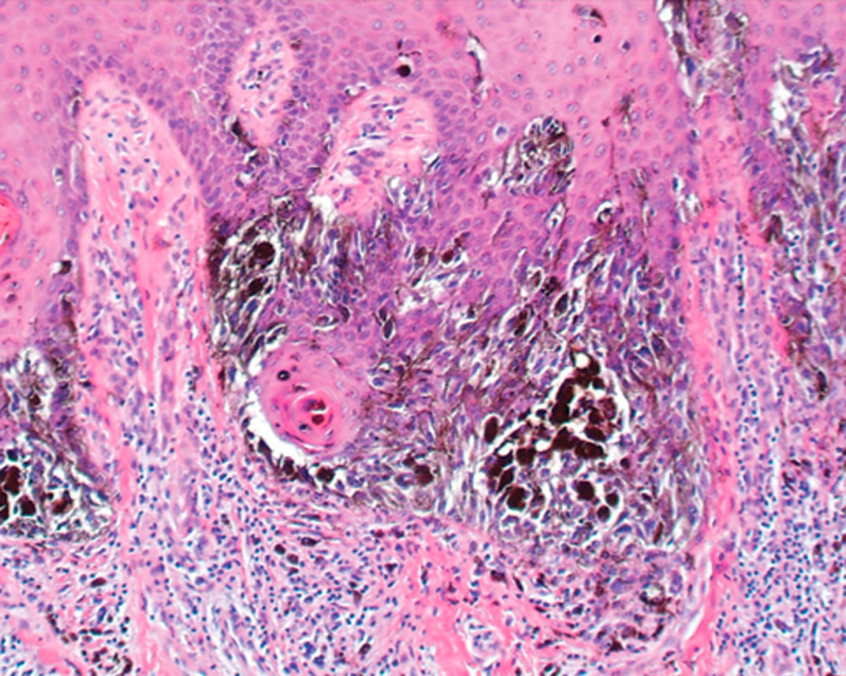 Fig. 7.3, Acral lentiginous melanoma. Large, dendritic, pigmented melanocytes arranged in single cells and nests at all levels of the epidermis.