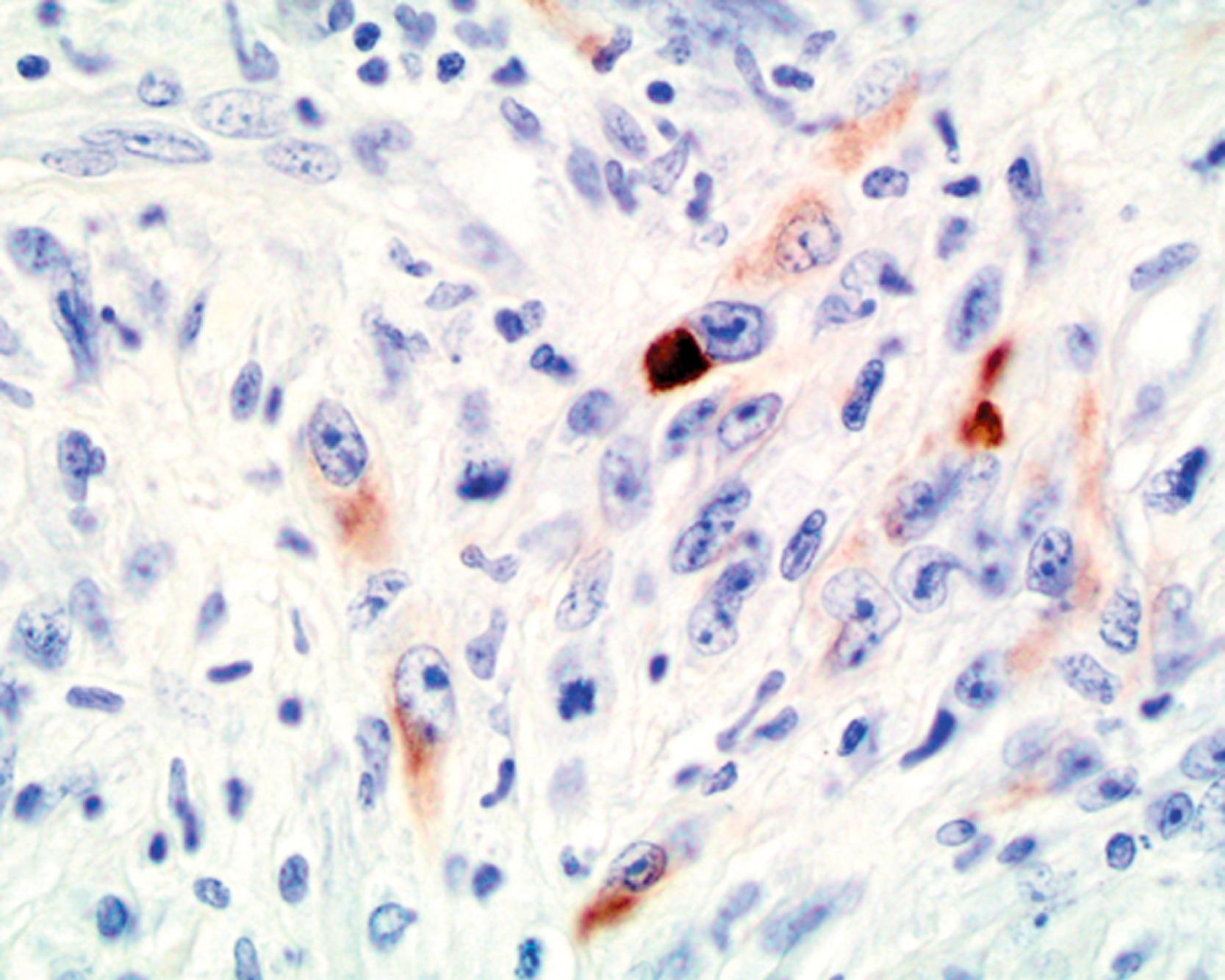 Fig. 7.5, Keratin is only rarely expressed in melanoma paraffin sections, usually low-molecular-weight keratins, and in a patchy manner (antikeratin “cocktail” AE1/AE3, CAM5.2, Zym5.2, and MNF116 and diaminobenzidine).