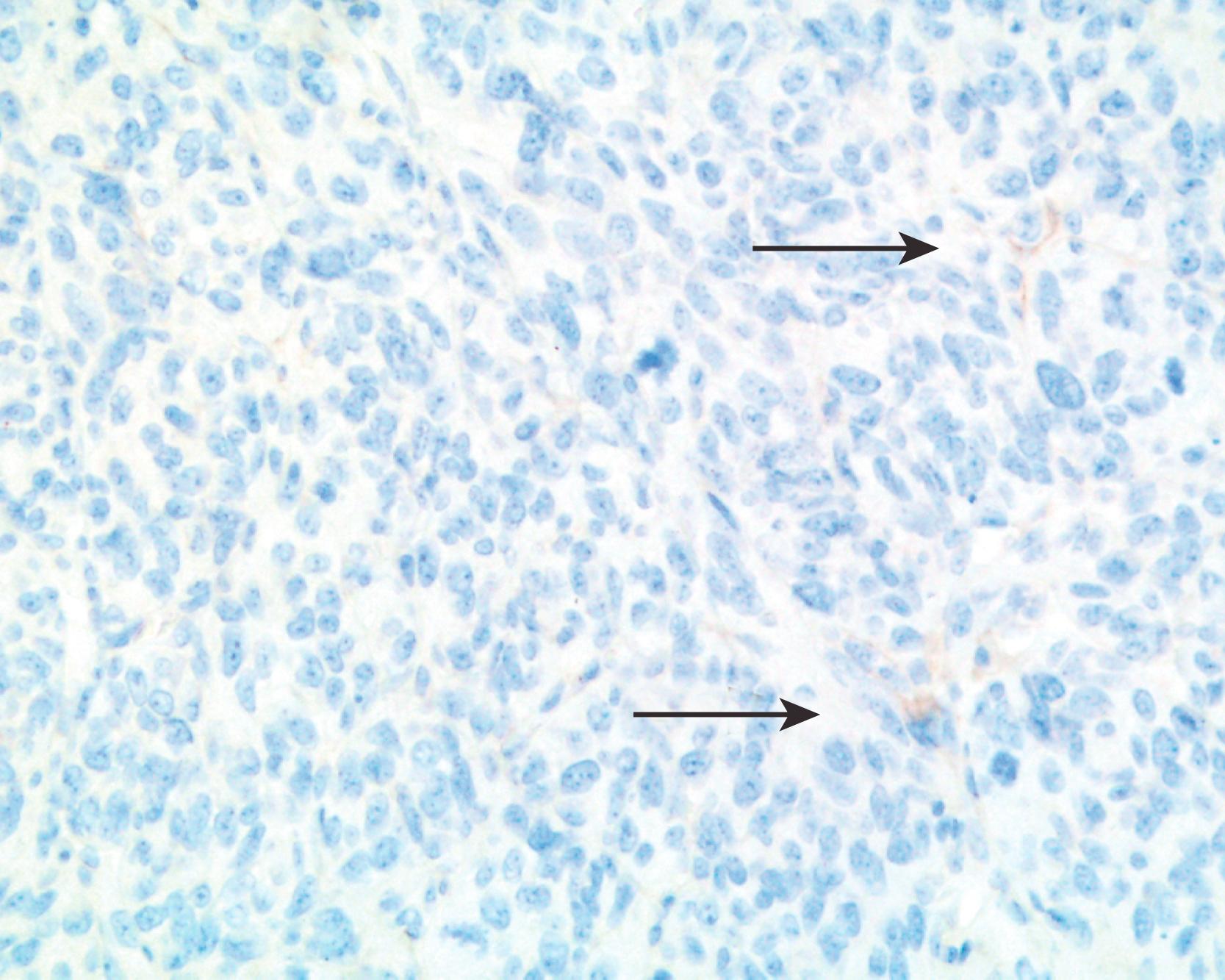 Fig. 7.6, Poorly differentiated, amelanotic melanoma focally expresses epithelial membrane antigen (EMA; arrows ), anti-EMA, and diaminobenzidine.