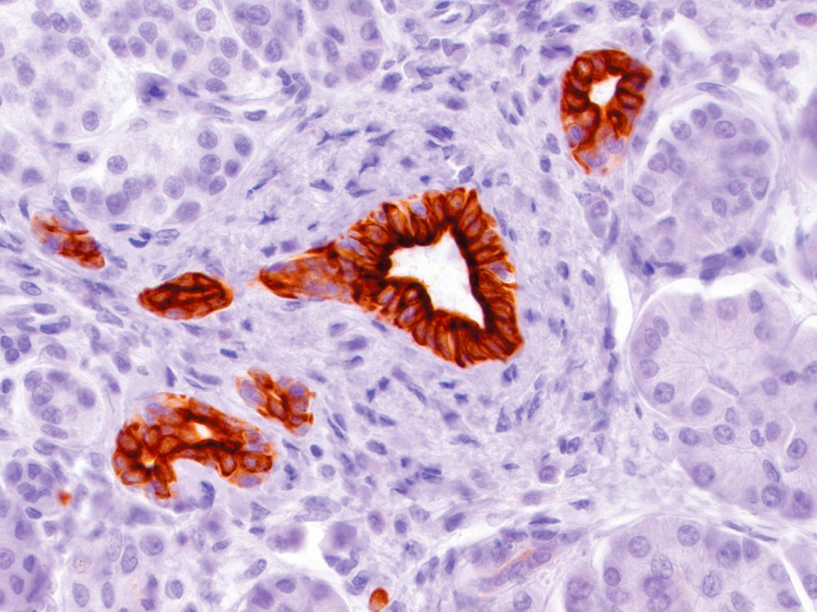 Fig. 15.1, Pancreatic ductal cells are strongly positive for cytokeratin 7, whereas acinar cells generally do not label with this marker.