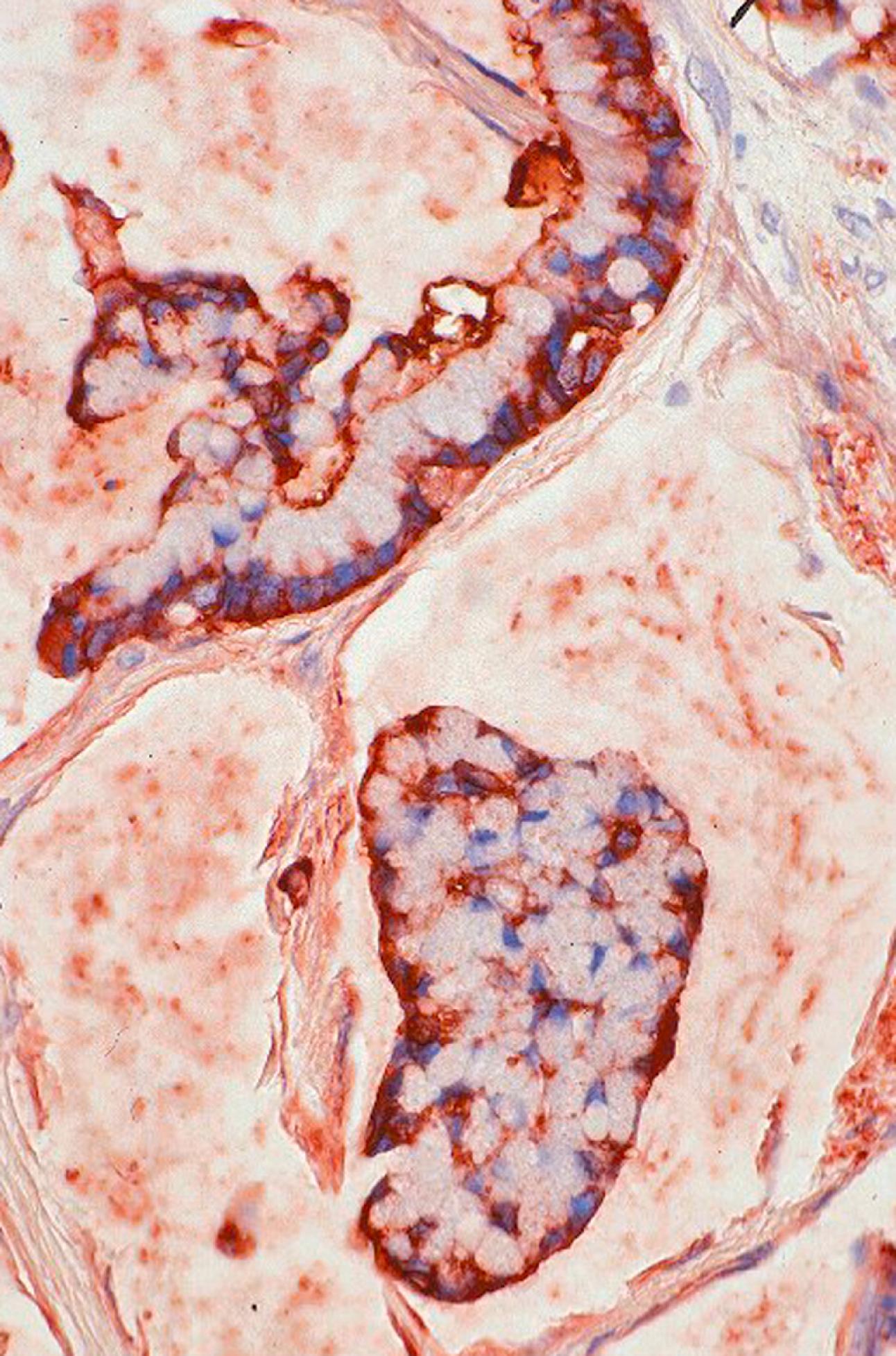 Fig. 15.11, In contrast to MUC2, intracytoplasmic monoclonal carcinoembryonic antigen (mCEA) labeling is much weaker in colloid carcinoma; however, there is strong mCEA labeling in the stroma-facing surface of the cells.