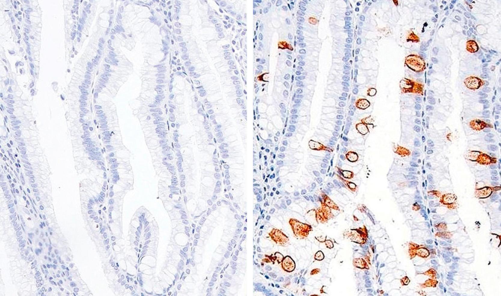 Fig. 15.13, Intraductal papillary mucinous neoplasm with gastric/foveolar type papillae are usually negative for MUC1 (left) . MUC2 expression is only focal, marking goblet cells (right) .