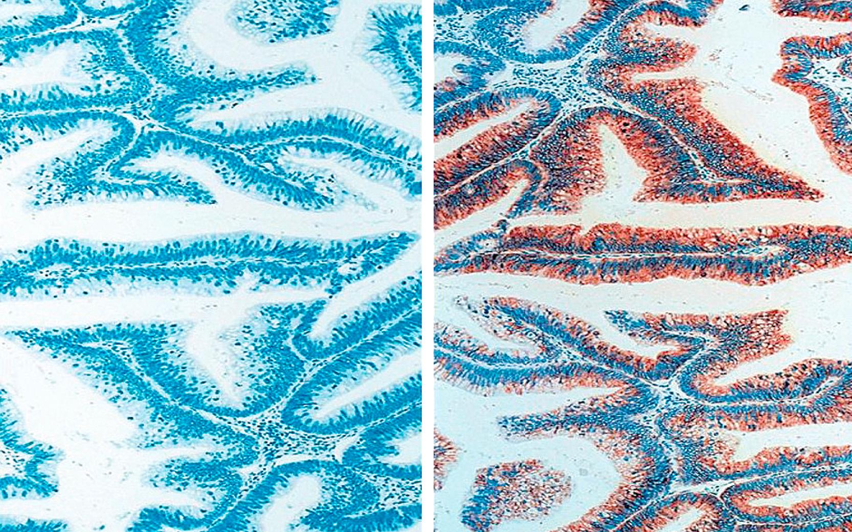 Fig. 15.14, Most intestinal-type intraductal papillary mucinous neoplasm papillae are negative for MUC1 (left) . MUC2 expression is diffuse and strong (right) .