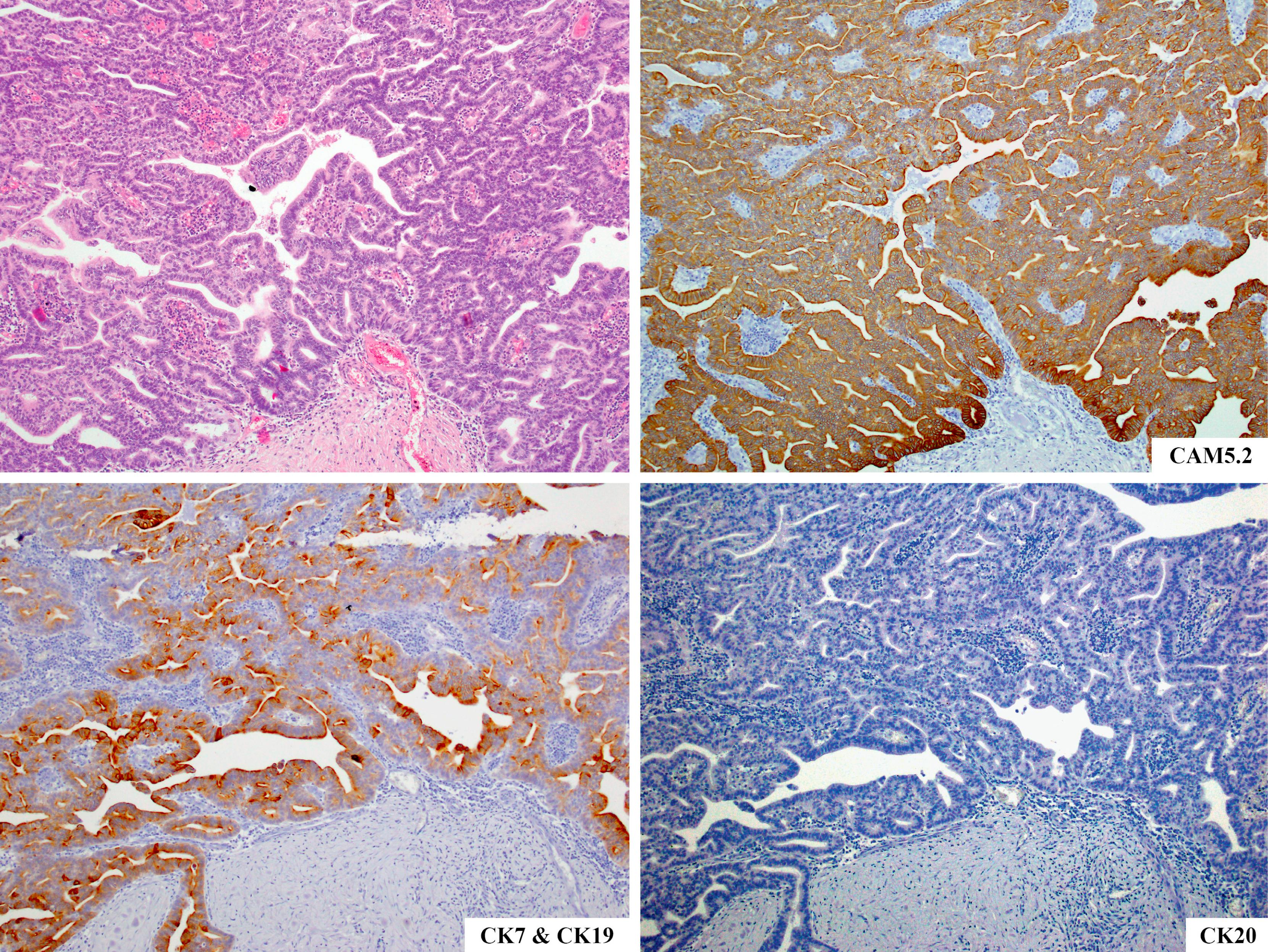 Fig. 15.15, Intraductal tubulopapillary neoplasms (ITPNs), like most other pancreatic neoplasms, label with wide-spectrum (AE1/AE3 and CAM5.2) and specific (CK7 and CK19) cytokeratin antibodies. However, intestinal differentiation markers (CK20 and MUC2) are not expressed in ITPNs.