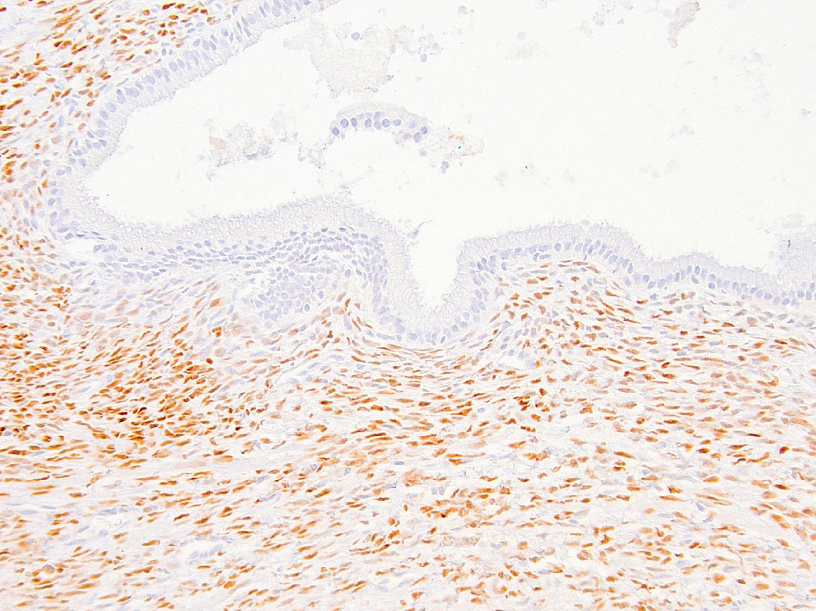 Fig. 15.16, Progesterone receptors are expressed in the ovarian-type stroma cells and may be used to confirm the diagnosis in equivocal cases of mucinous cystic neoplasms.