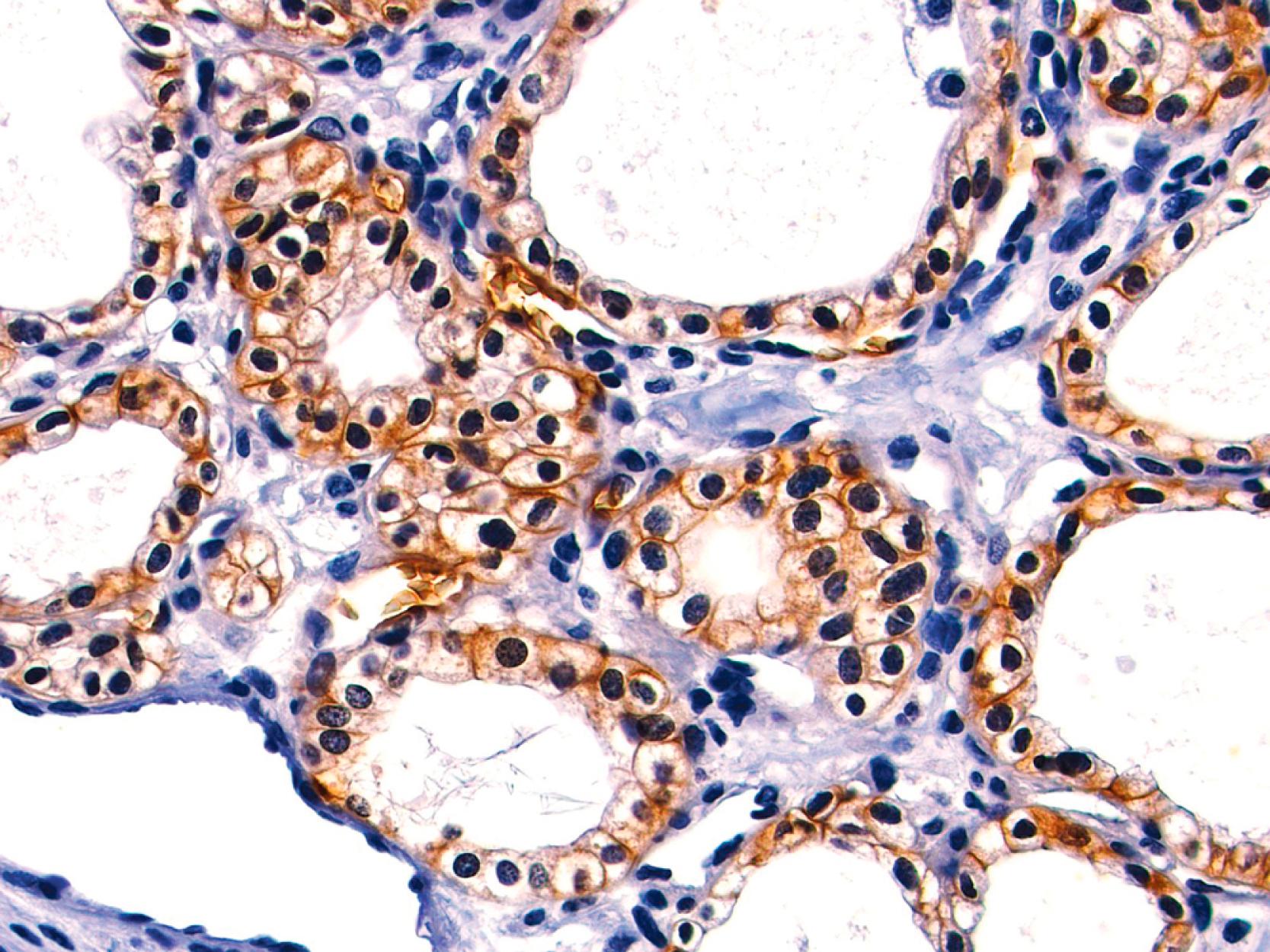 Fig. 15.17, GLUT-1 expression in serous cystadenoma is not only detected predominantly in the cell membranes, but also in the cytoplasm.