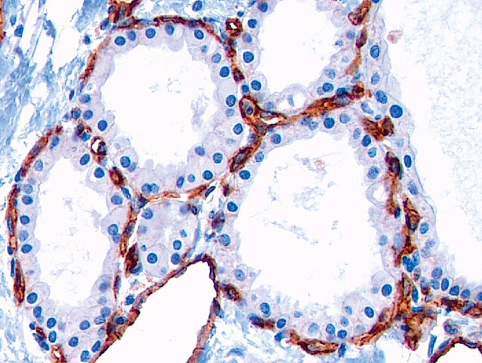 Fig. 15.18, The remarkable intensity of capillary network immediately adjacent to the epithelium, highlighted by CD31, in serous cystadenoma.