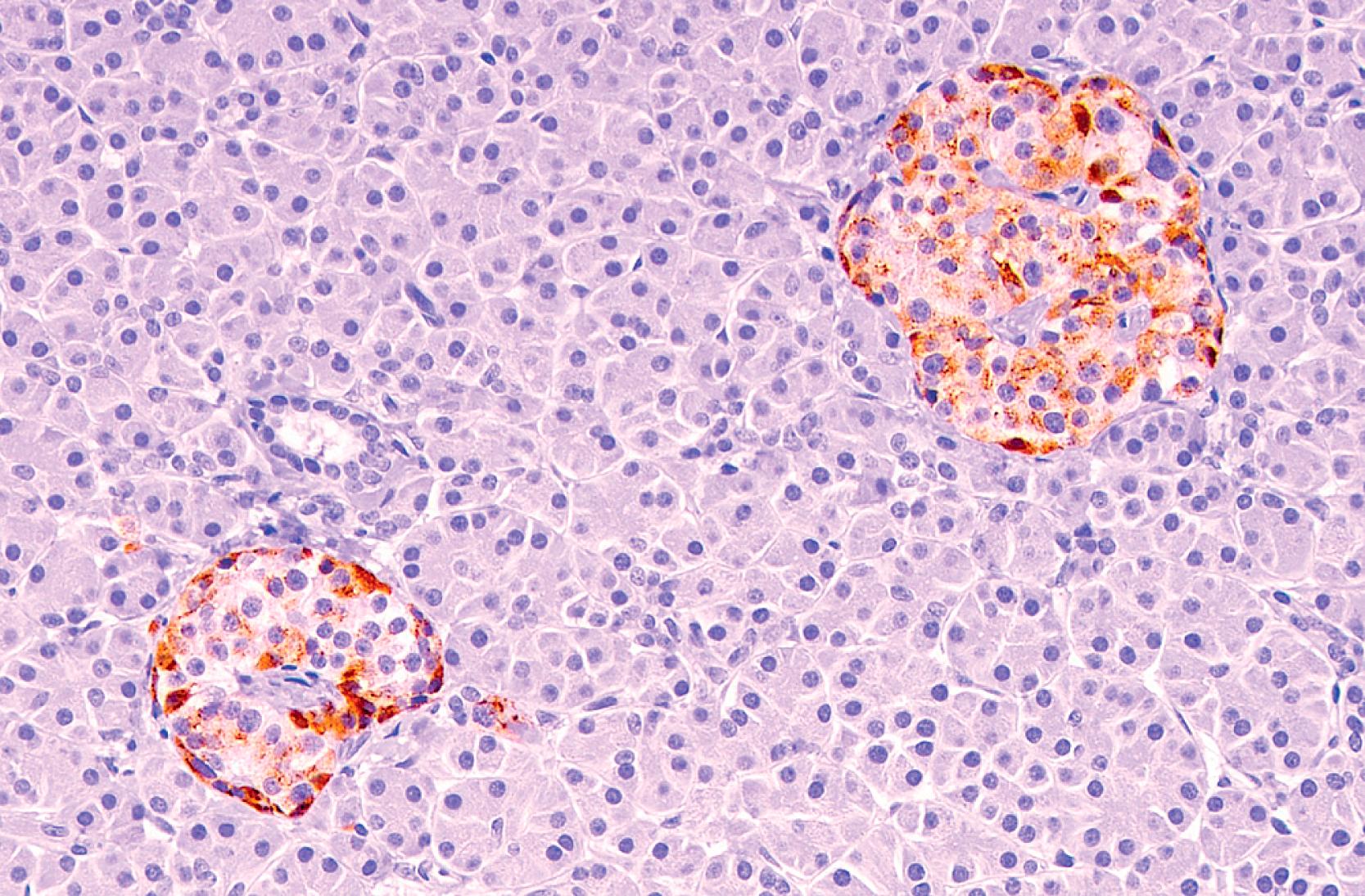 Fig. 15.2, Immunohistochemistry for chromogranin shows strong positive staining in islets of Langerhans, which is more prominent in the peripheral cells. Ducts and acini are negative.