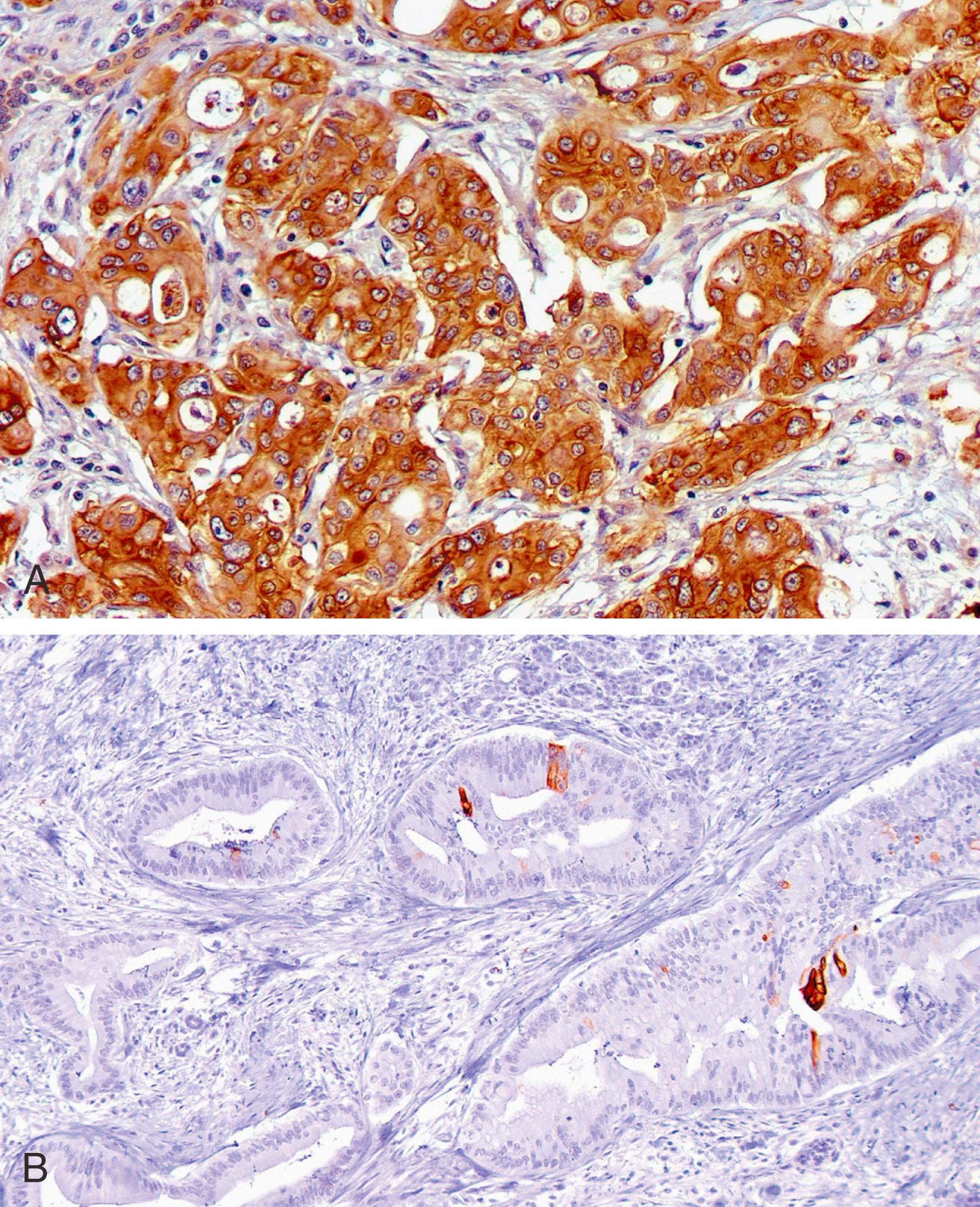 Fig. 15.4, CK7 is expressed diffusely and strongly in the vast majority of ductal adenocarcinoma cases (A); however, CK20 expression is less common and is usually focal (B).