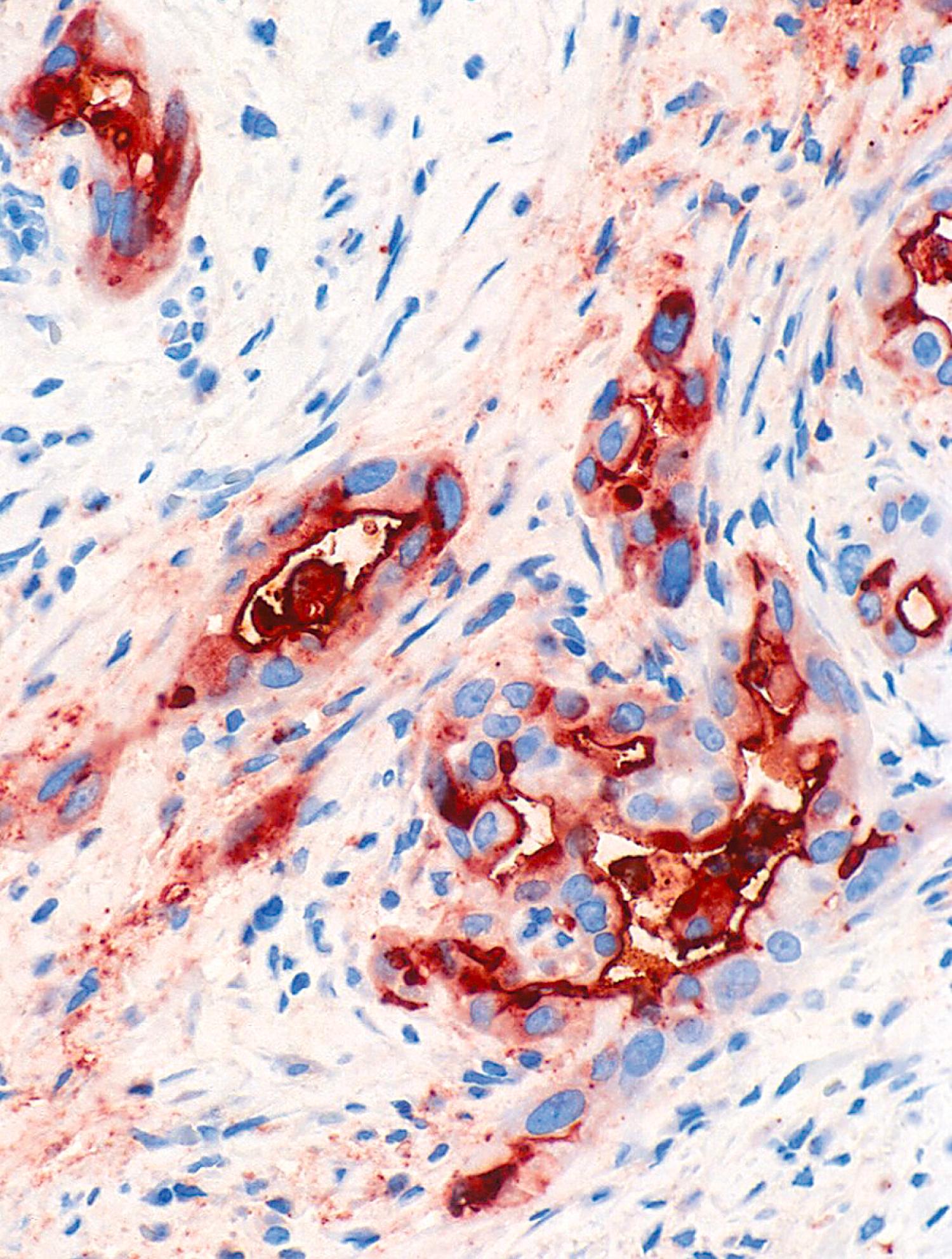 Fig. 15.6, MUC1 is expressed in all pancreatobiliary type adenocarcinomas (invasive ductal adenocarcinoma of the pancreas is shown here). Whereas the expression is predominantly confined to the luminal membrane in the duct forming areas, it is also intracytoplasmic in the poorly differentiated areas.