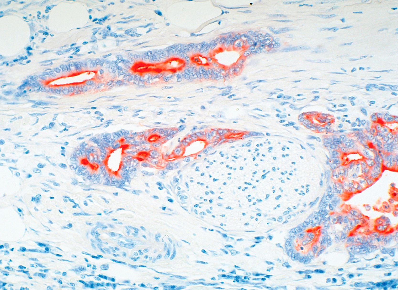 Fig. 15.7, Monoclonal carcinoembryonic antigen (mCEA) labeling in ductal adenocarcinoma, areas of well-defined tubule formation showing more luminal surface labeling, and poorly differentiated areas displaying more intense cytoplasmic expression. Nonneoplastic glands are often negative or only focally positive for this marker. However, it should be kept in mind that overlaps do happen.